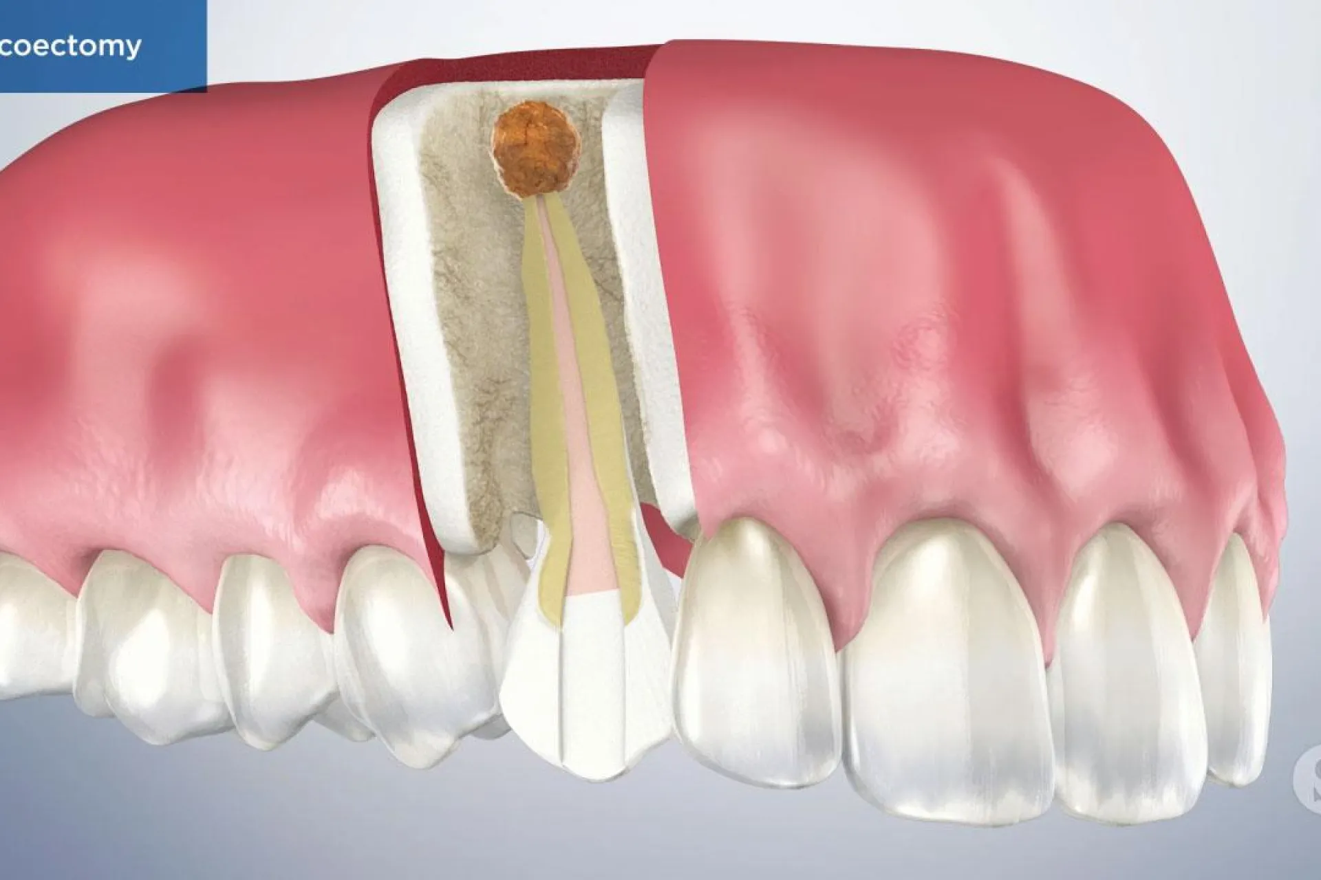 A video still - Apicoectomy with an image showing a close up with one tooth seeing through the gums to see the root of tooth and apicoectomy.