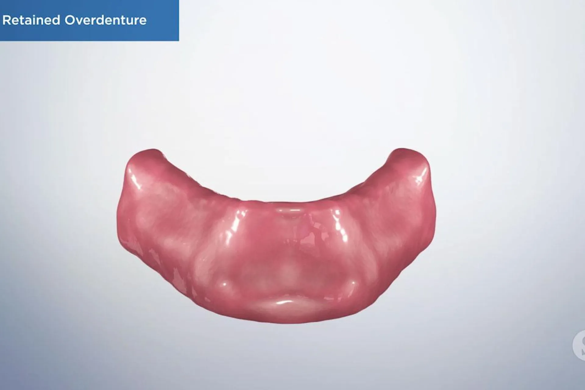 A video still - Bar Retained Overdenture with an image showing the bottom gum line.
