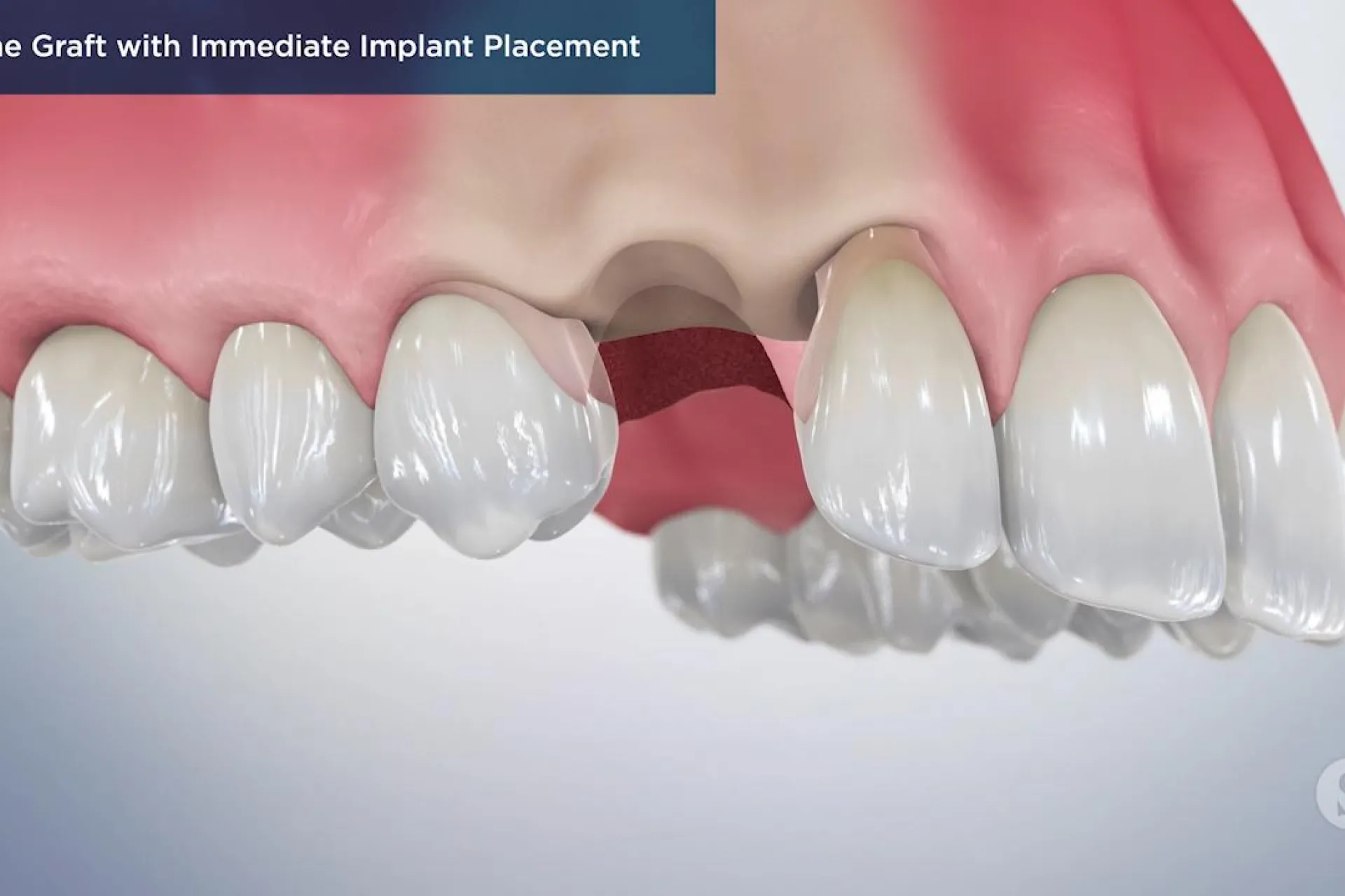 A video still - Bone Graft with Immediate Implant Placement with an image showing the top teeth with a missing tooth.