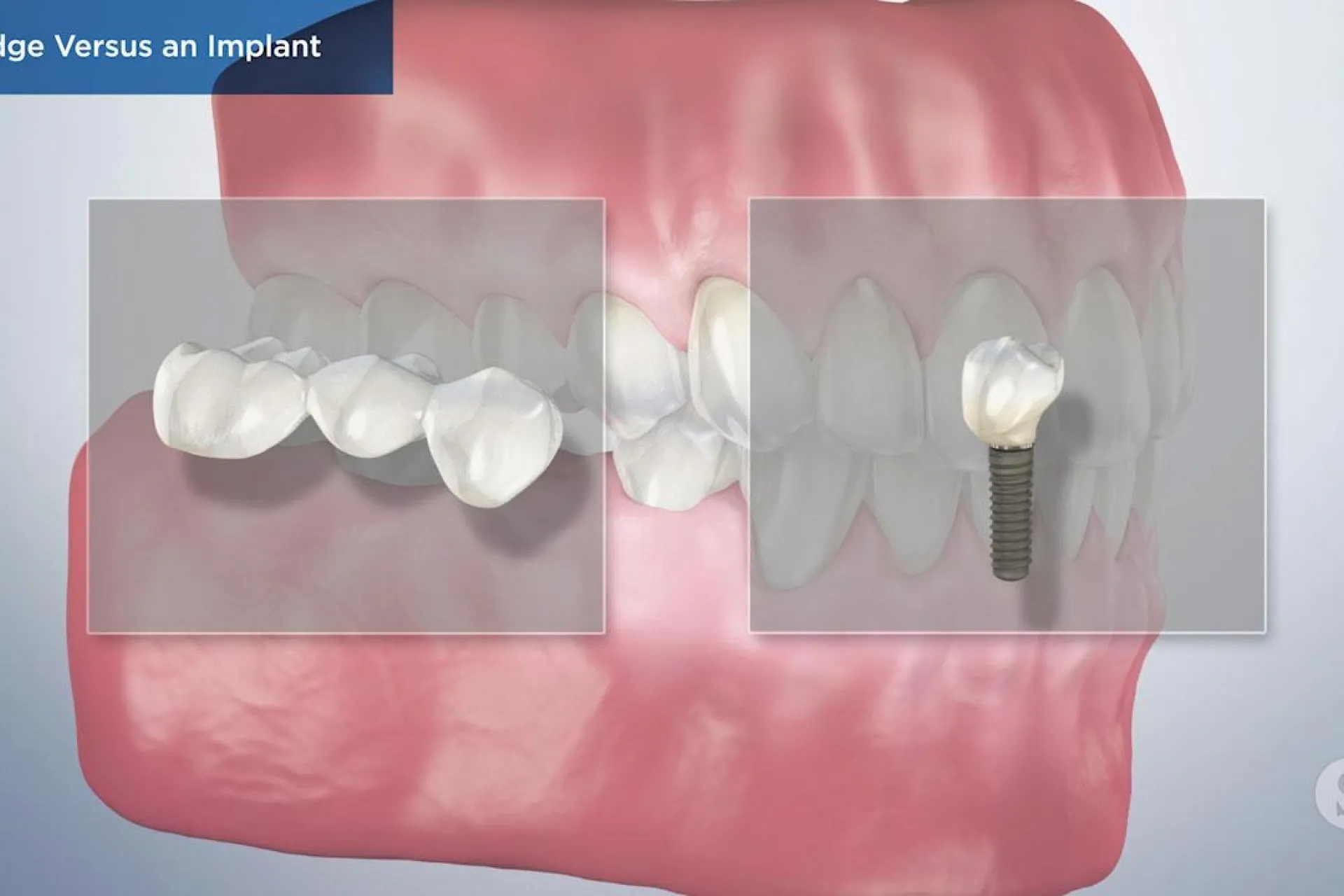 A video still - Bridge Versus an Implant with an image showing a mouth and two square boxes in front with the left box having an bridge 3d image and the right box having a 3d image of an implant.