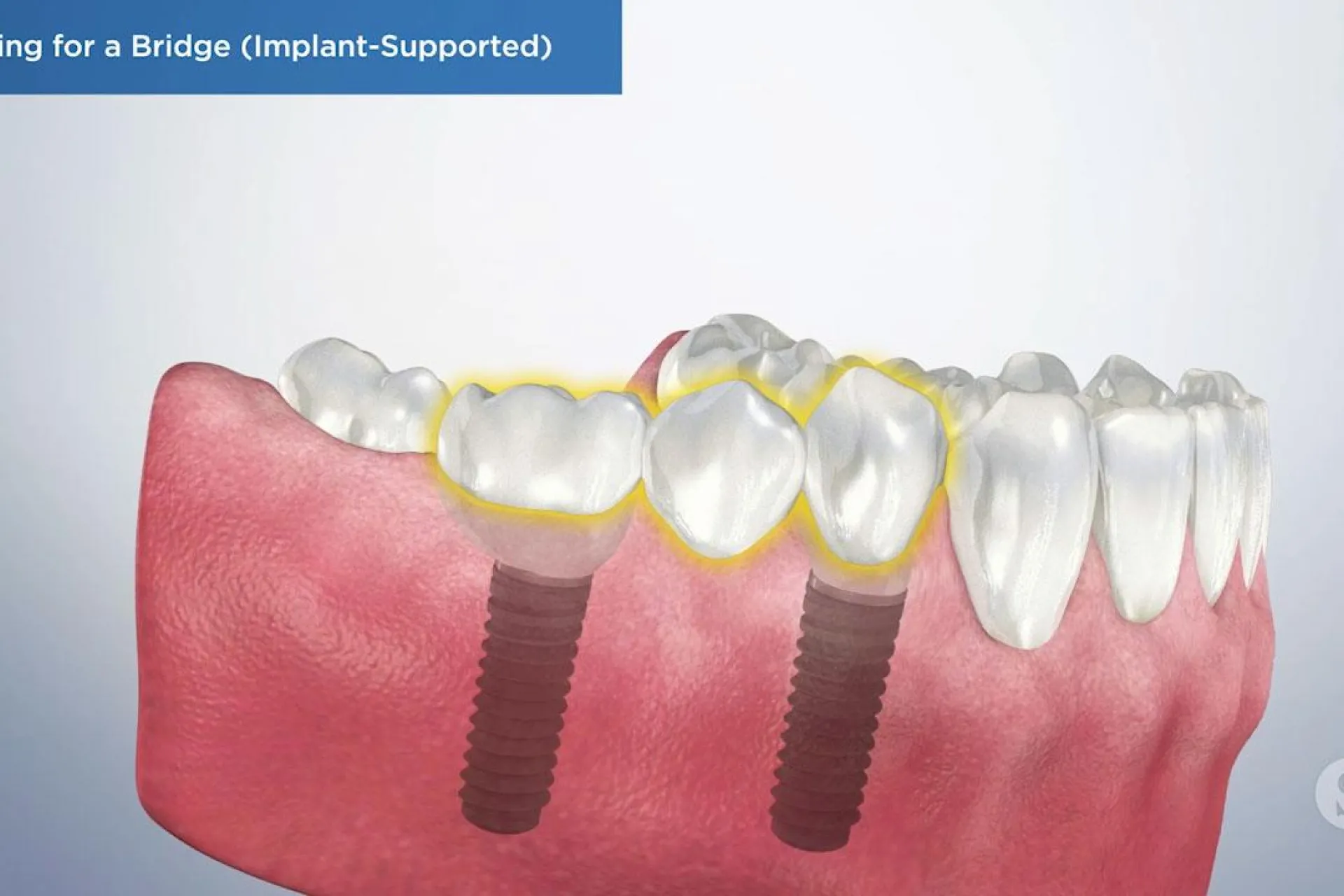 A video still - Caring for a Bridge (Implant-Support) with an image showing the bottom row of teeth with implants.