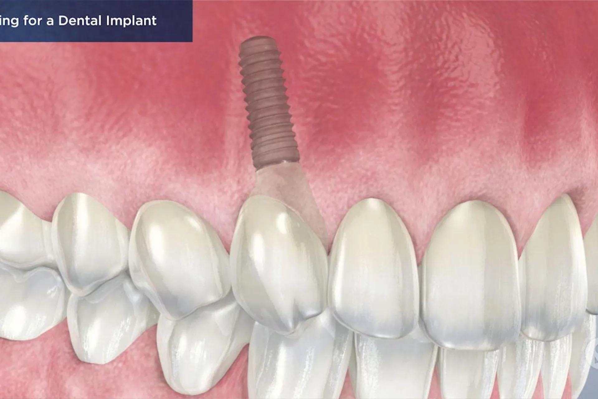A video still - Caring for a Dental Implant with an image showing a smile with the implant.