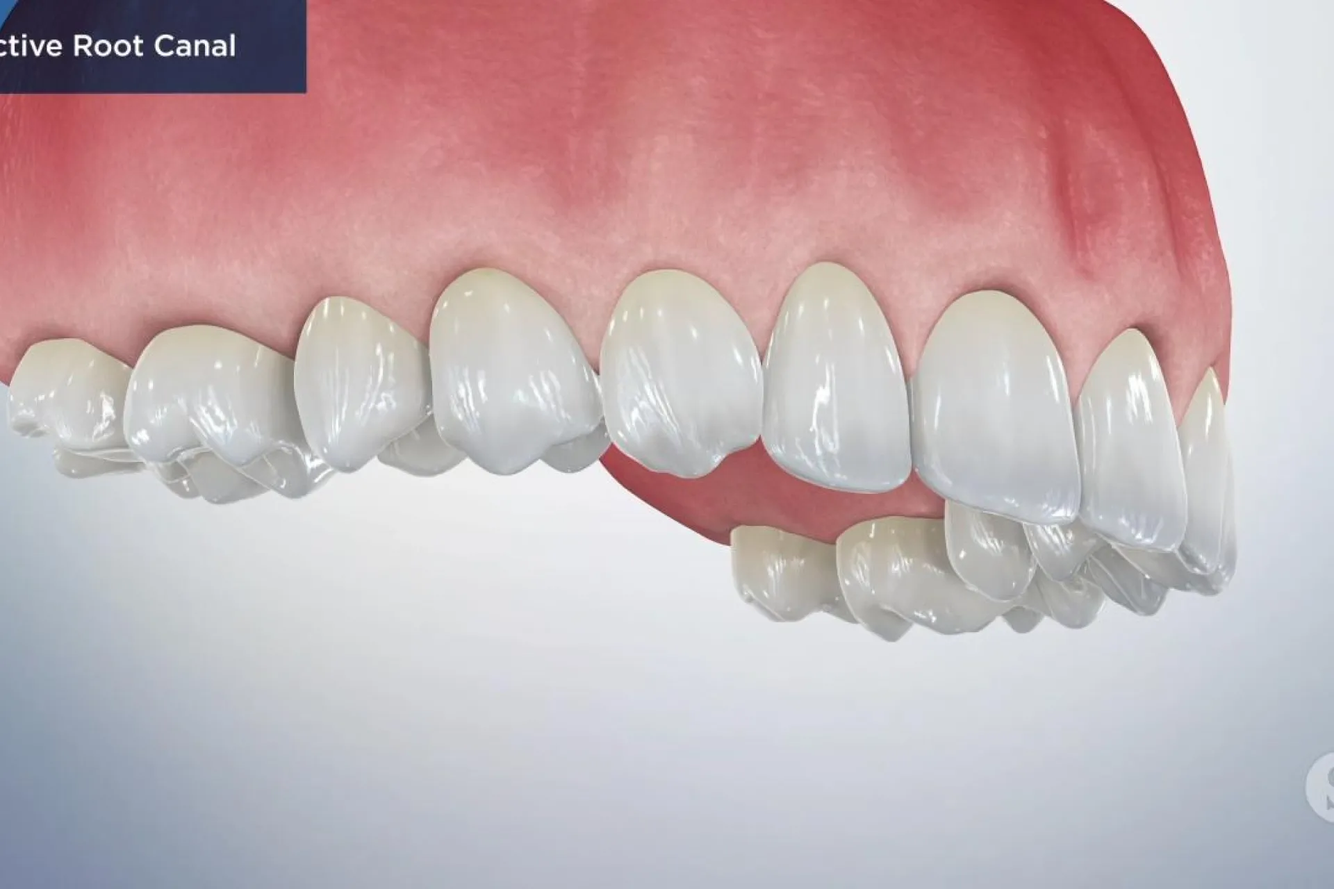 A video still - Elective Root Canal with an image still of the top teeth and gums.