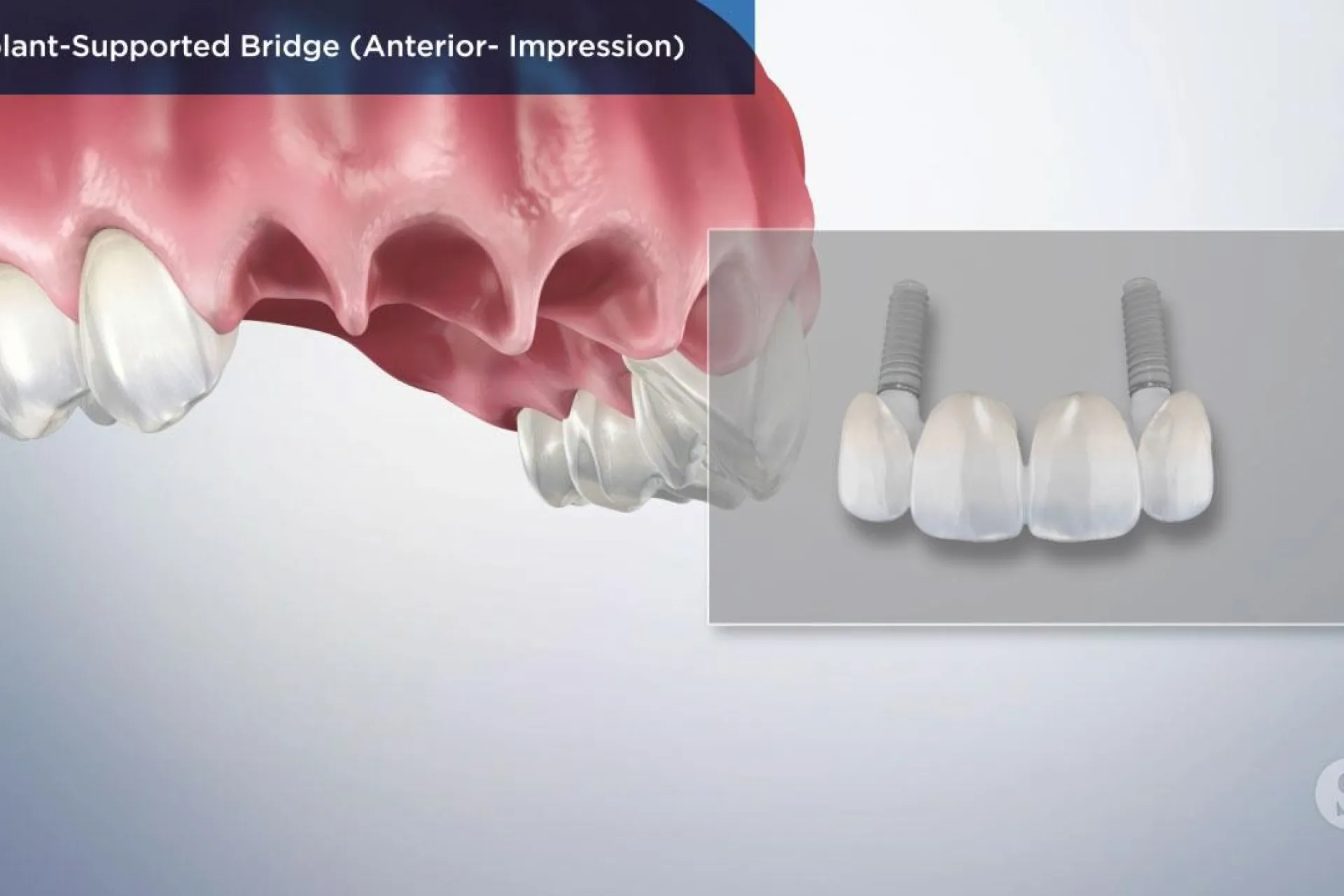A video still - Implant-Supported Bridge (Anterior - Impression) with an image showing the top row of teeth with the front missing and an image box with the replacement supported bridges.