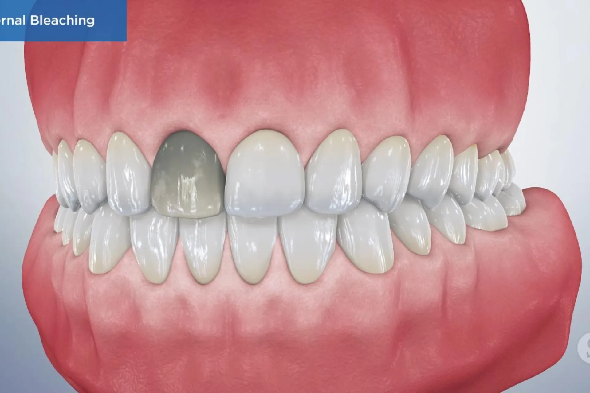 A video still - Internal Bleaching with an image showing a set of teeth with the front top tooth on the left that is gray.
