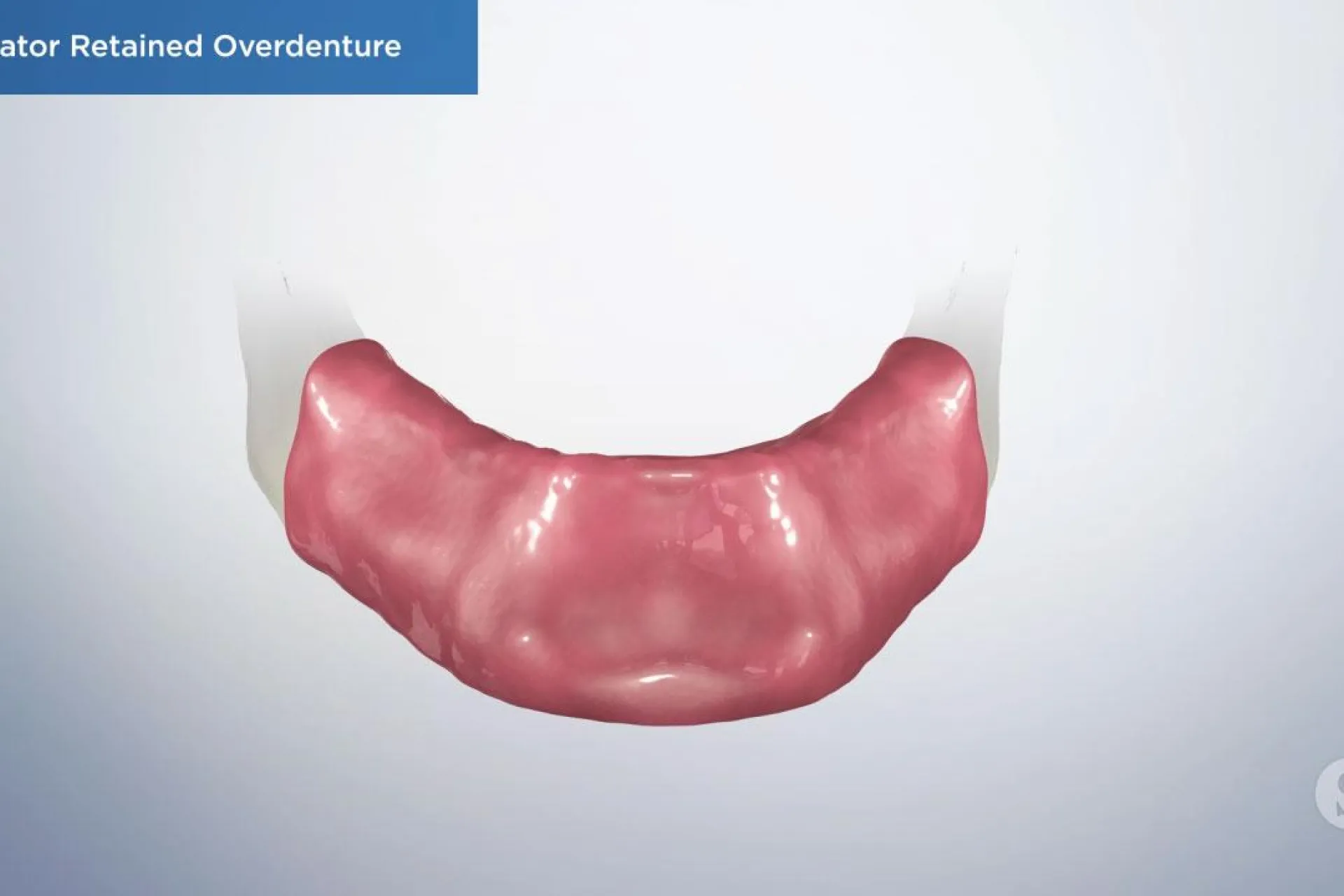 A video still - Locator Retained Overdenture with a image showing bottom mouth of the gums where the over denture will be placed.