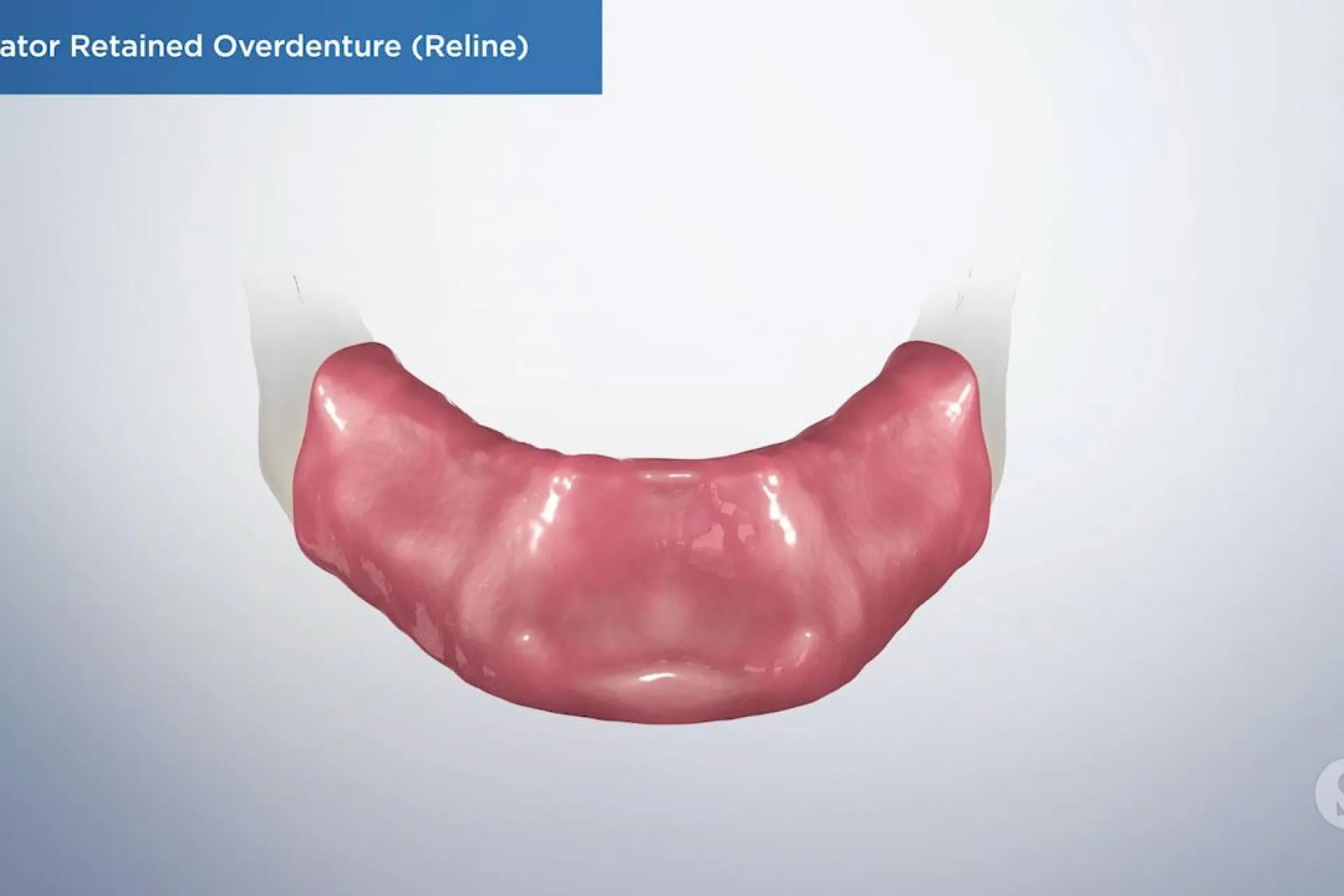 A video still - Locator Retained Overdenture (Reline) showing an image of the bottom gums.