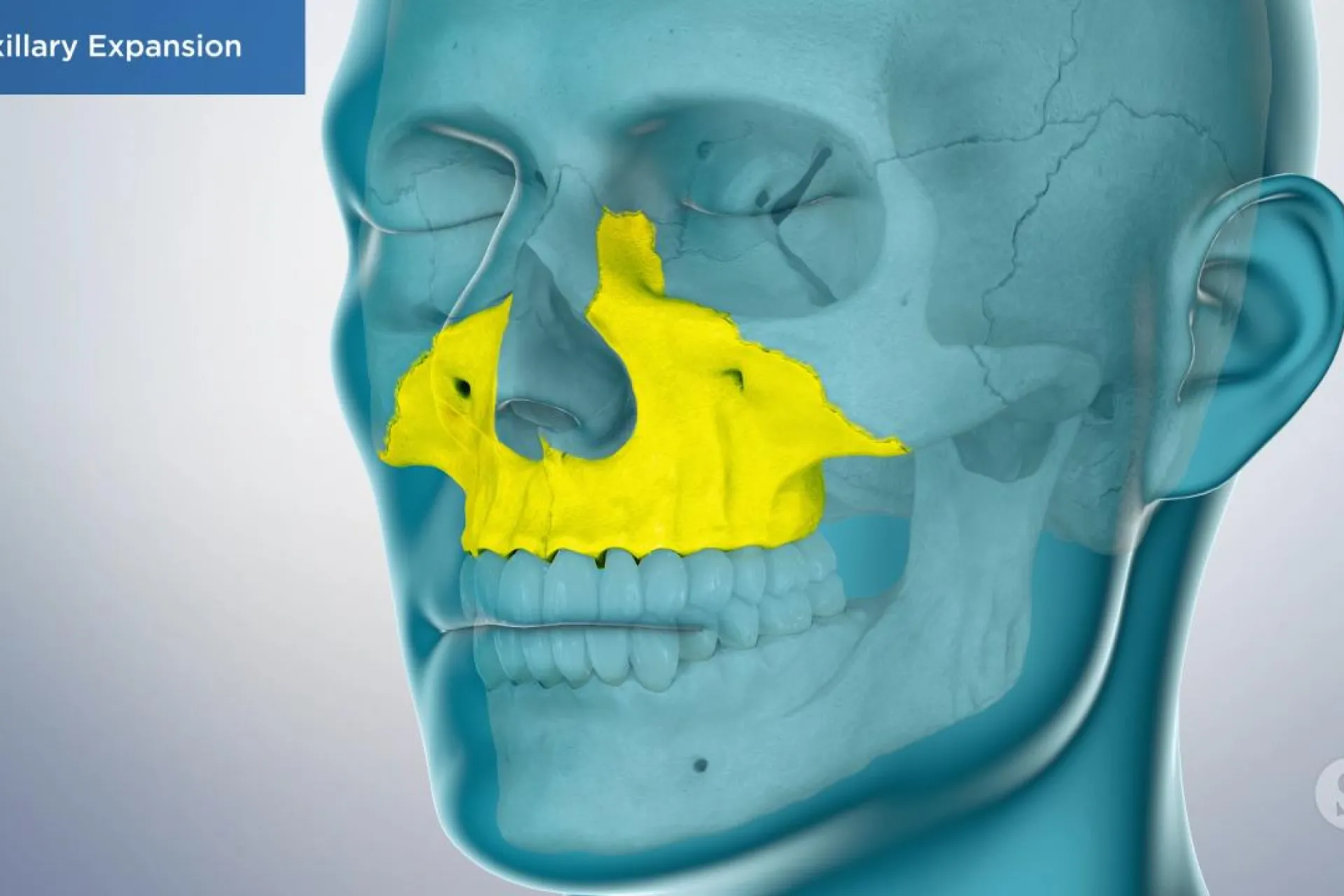 A video still - Maxillary Expansion with an image showing a side view of the skull and jaw with the upper jaw highlighted.