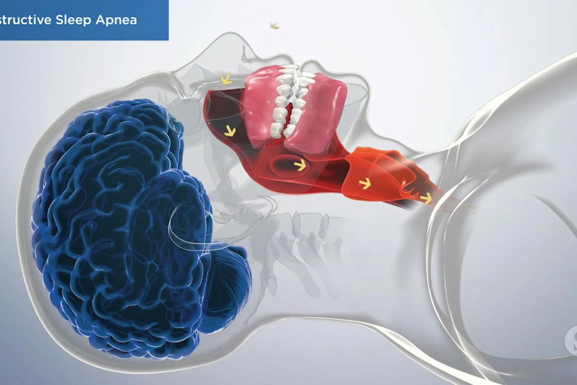 A video still - Obstructive Sleep Apnea with an image showing the throat muscles highlighted red to show it's opening with the airflow coming in.