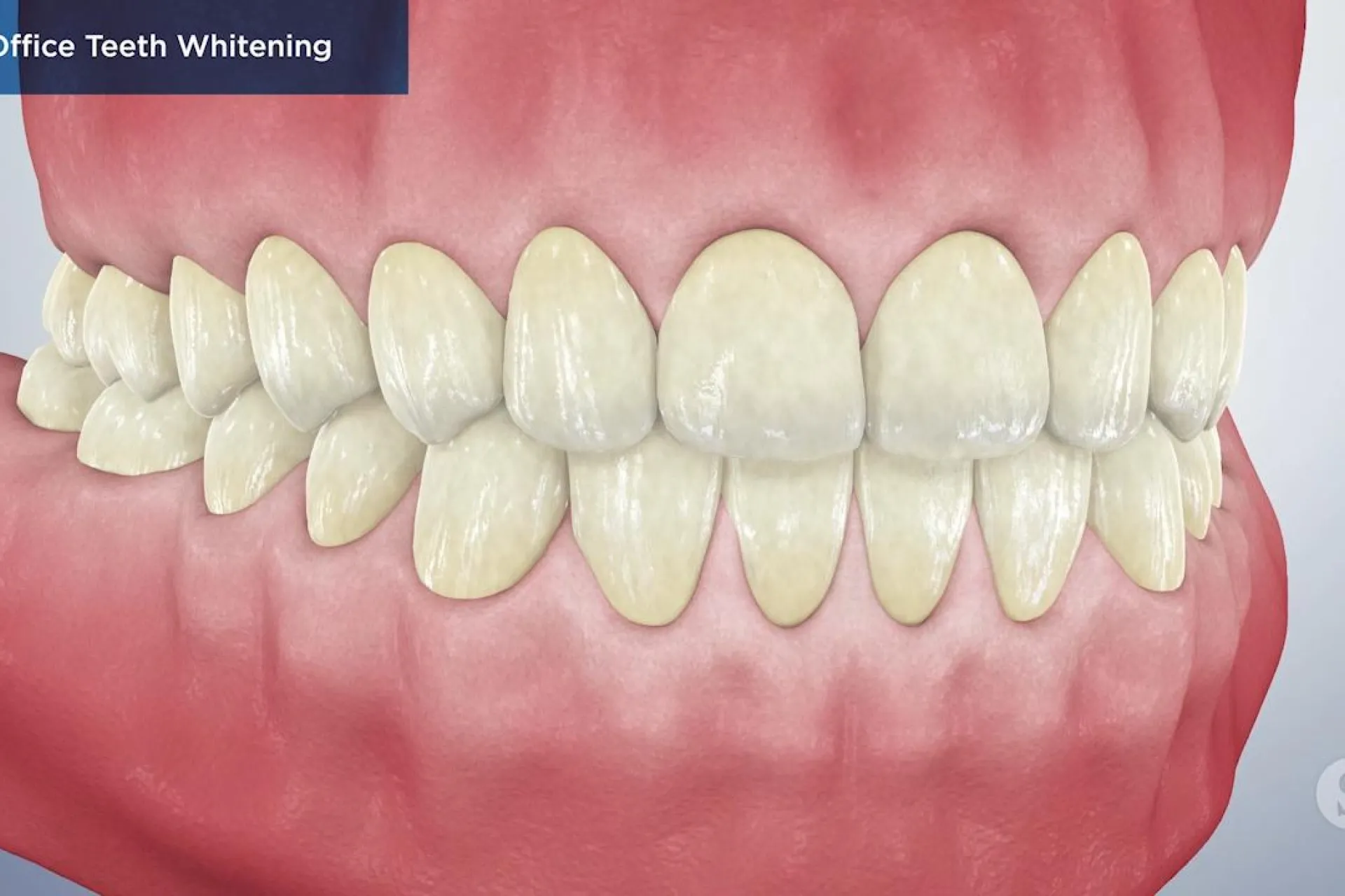 A video still - In-Office Teeth Whitening with an image showing a set of teeth and gums.