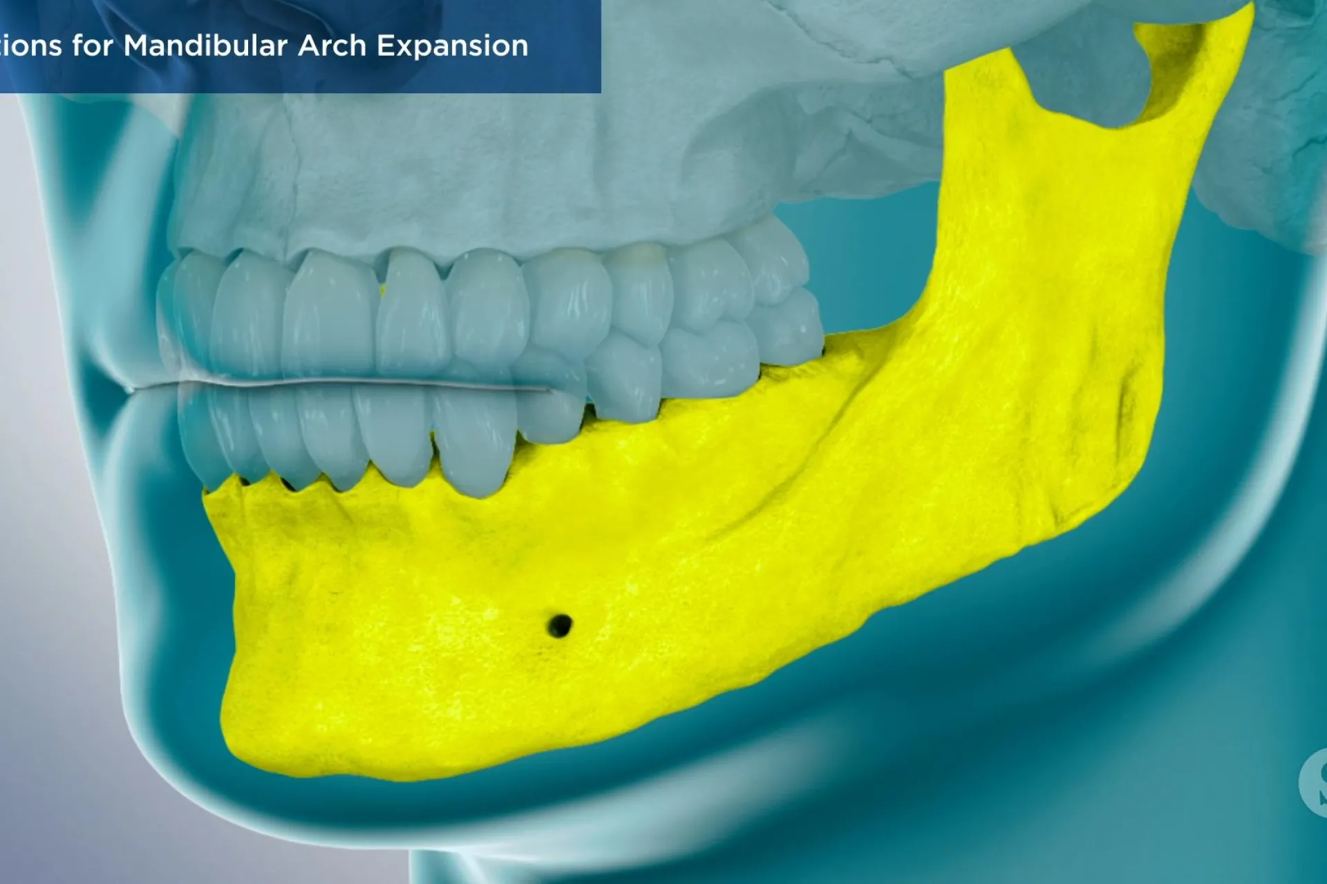 A video still - Options for Mandibular Arch Expansion with an image showing the lower jaw highlighted.