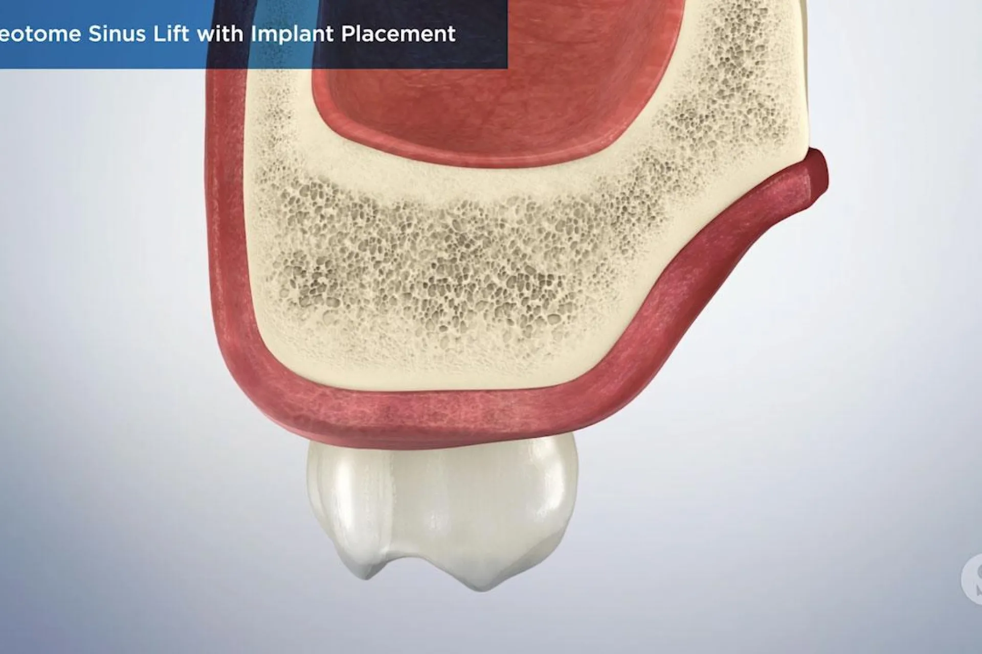 A video still - Osteotome Sinus Lift with Implant Placement with an image showing a close up of a tooth, gum and bone.