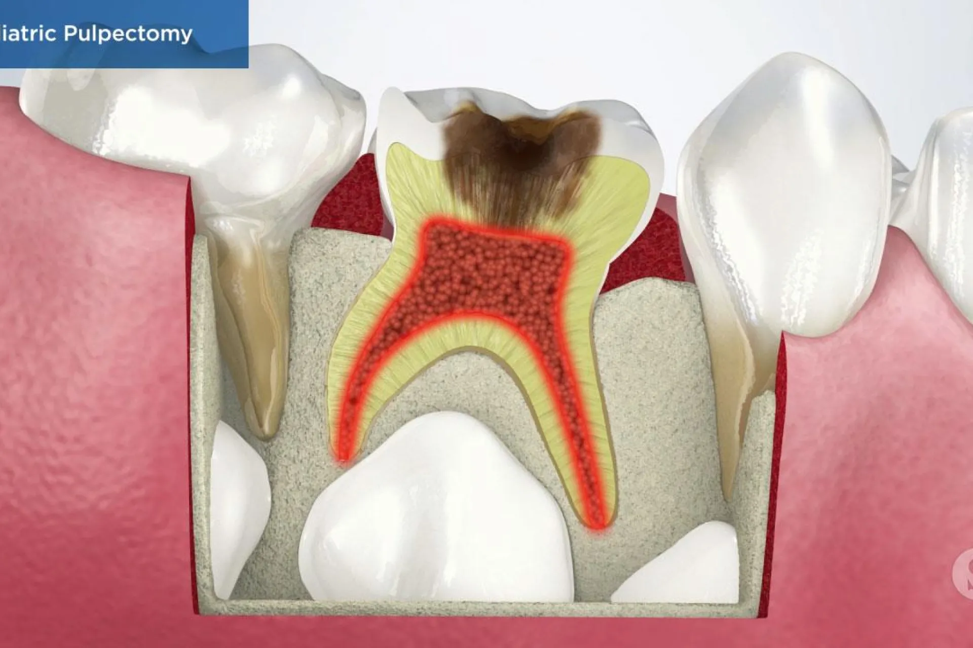 A video still - Pediatric Pulpectomy with an image still showing a close up of a child's tooth with the pulp inside of the tooth infected. 