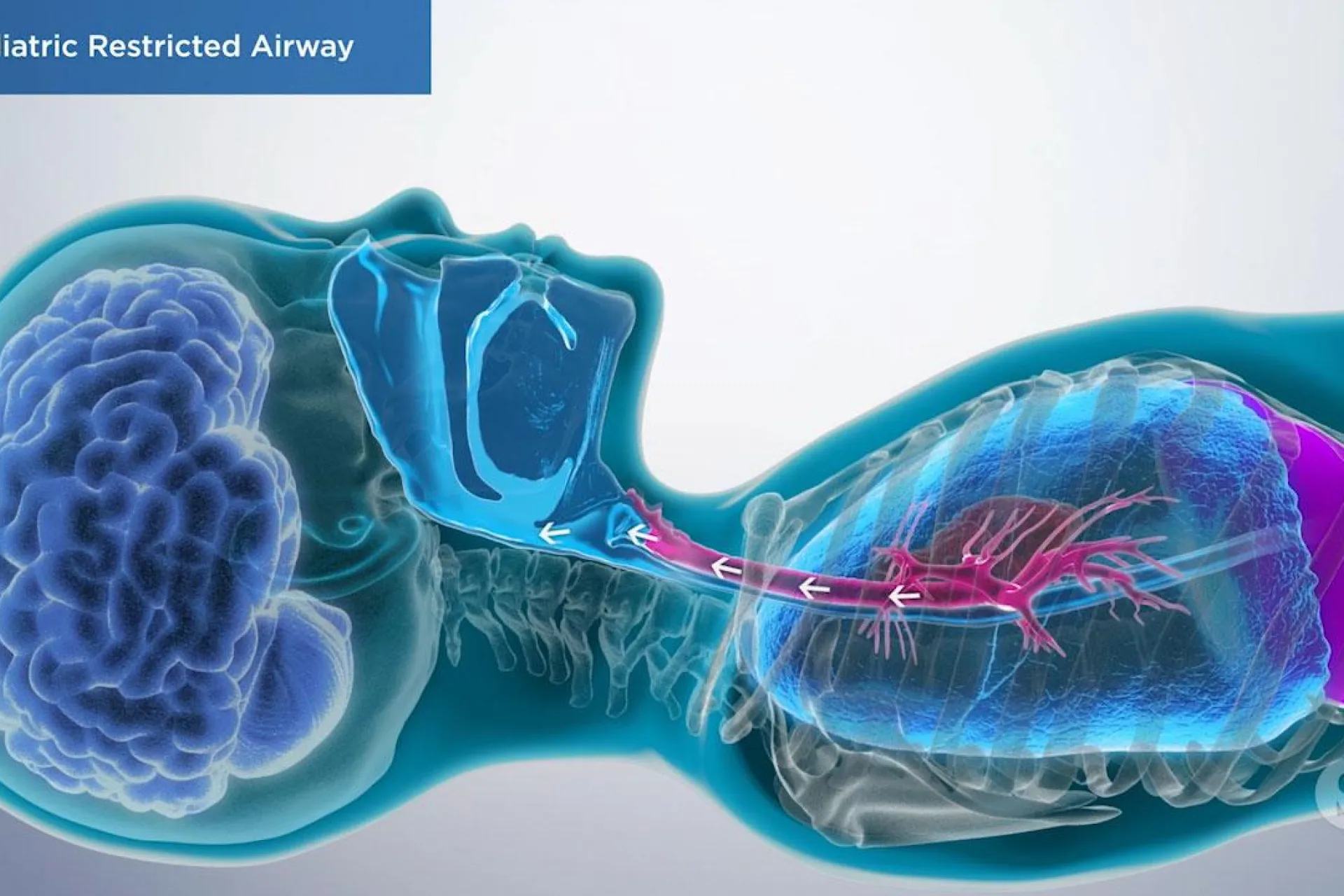 A video still - Pediatric Restricted Airway with an image showing a child laying down and the airflow and organs.