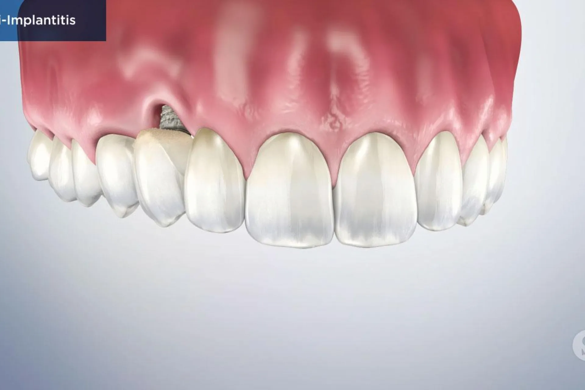 A video still - Peri-Implantitis with an image showing the top teeth and gums with a hole between one tooth and gumline.