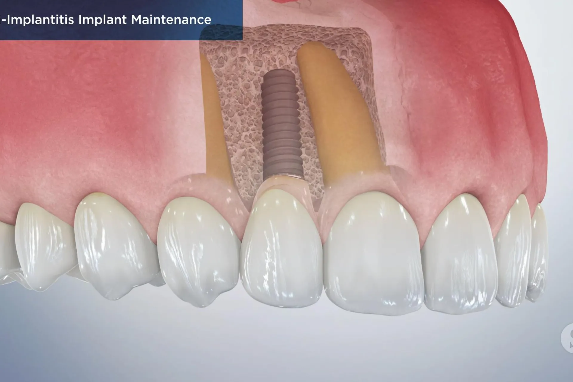A video still - Peri-Implantitis Implant Maintenance with an image showing a close up of the top teeth and gum with the implant and root in the gums.