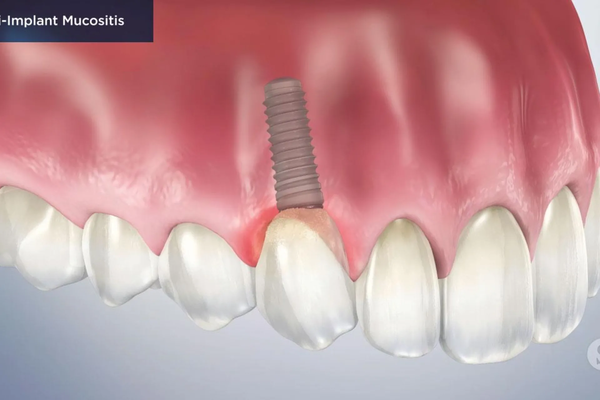 A video still - Peri Implant Mucositis with an image showing the top teeth and gum with a implant.