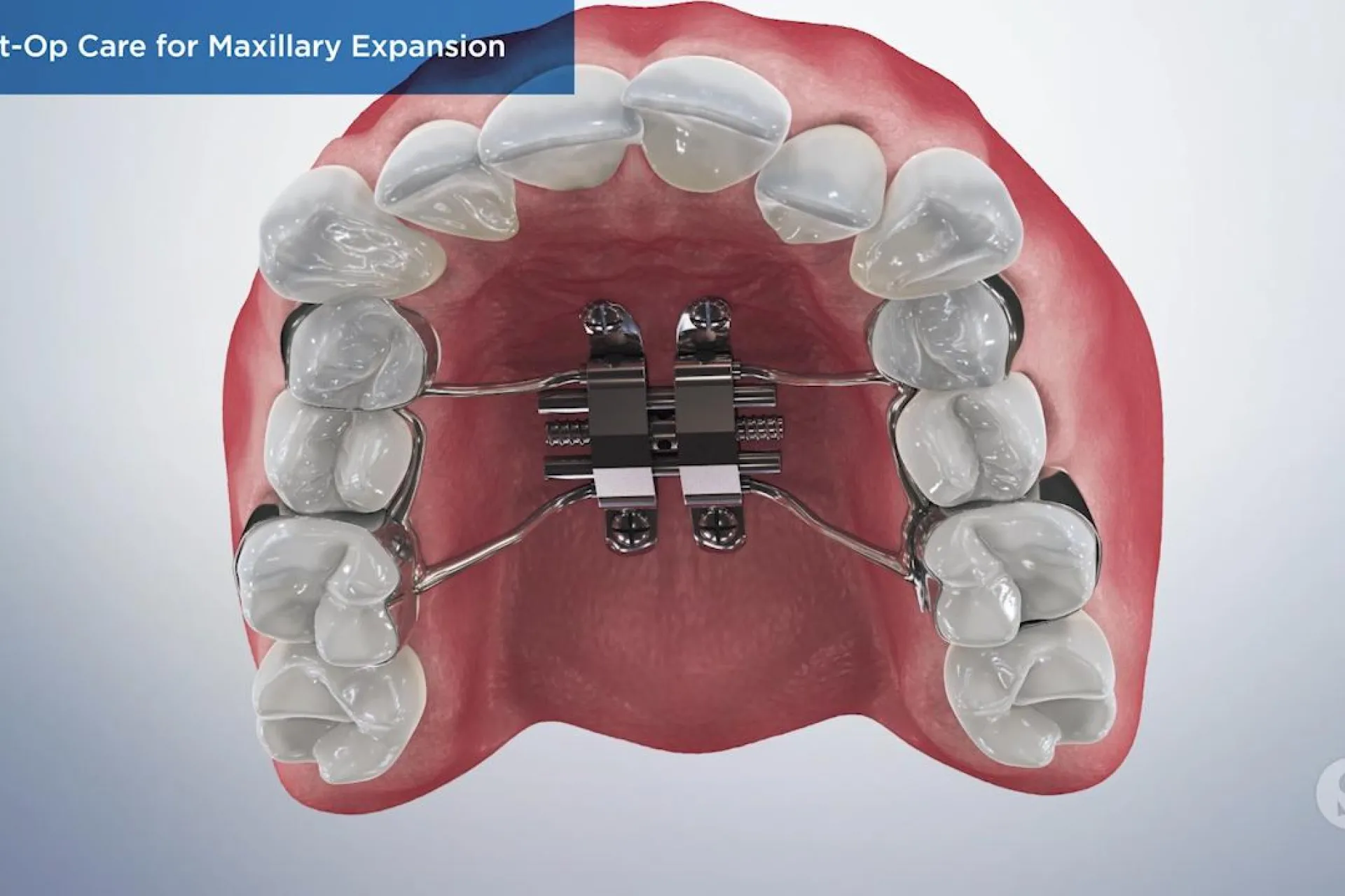 A video still - Post-Op Care for Maxillary Expansion with an image showing a close up of the top of the mouth with a maxillary expansion in.