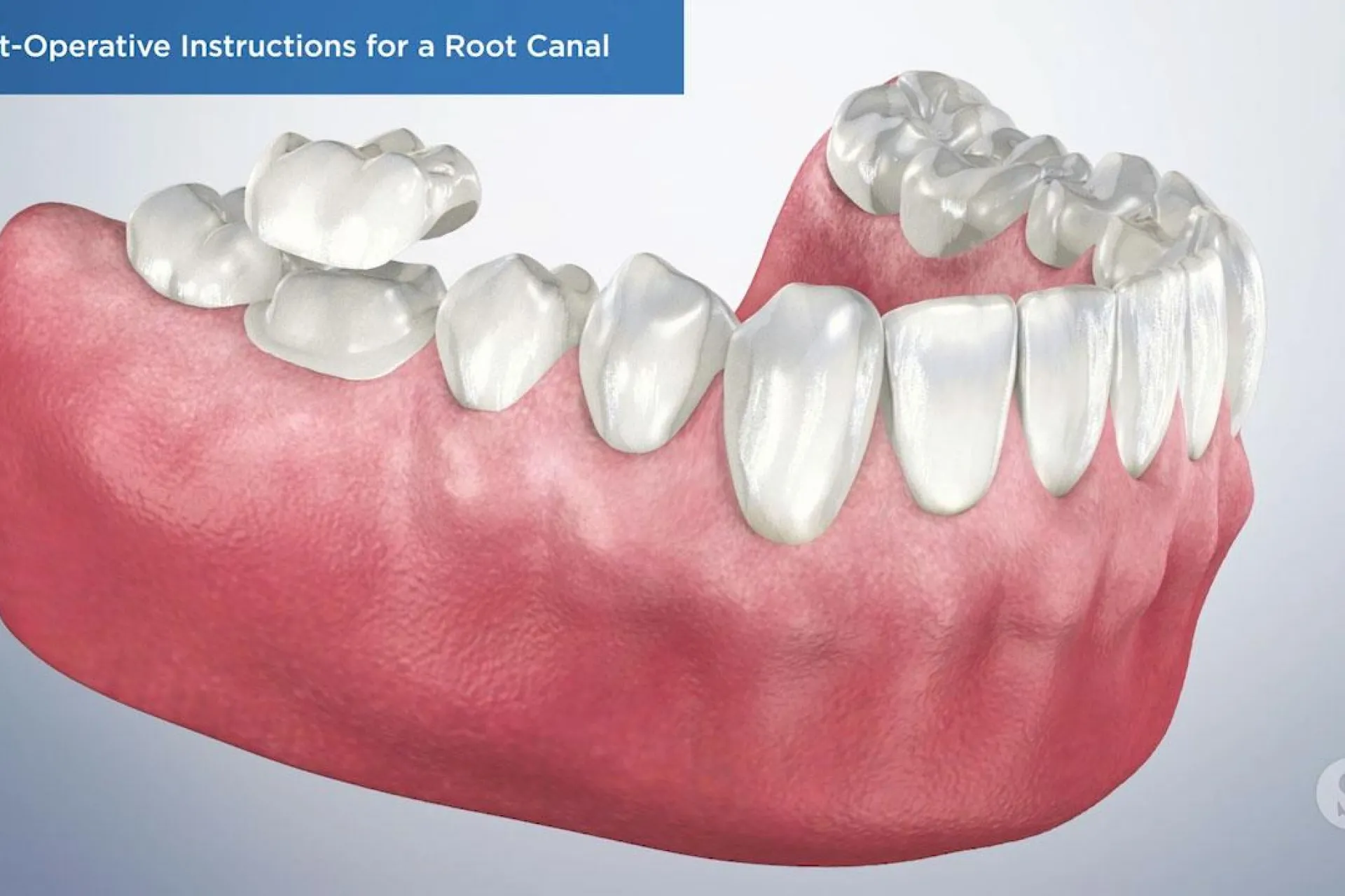 A video still - Post-Operative Instructions for a Root Canal with an image showing the bottom teeth and gums.