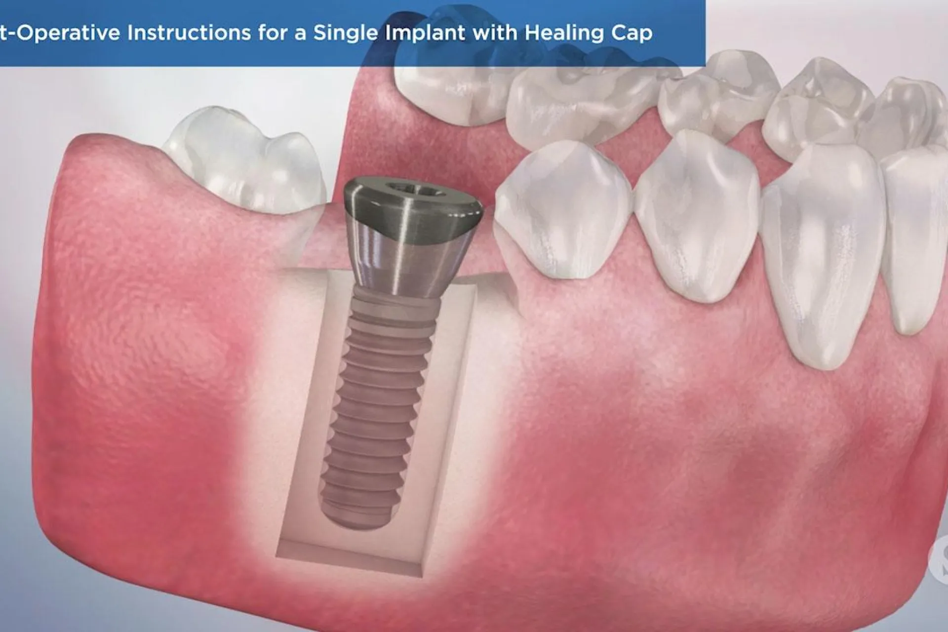 A video still - Post-Operative Instructions for a Single Implant with Healing Cap with an image showing an implant in the gum.