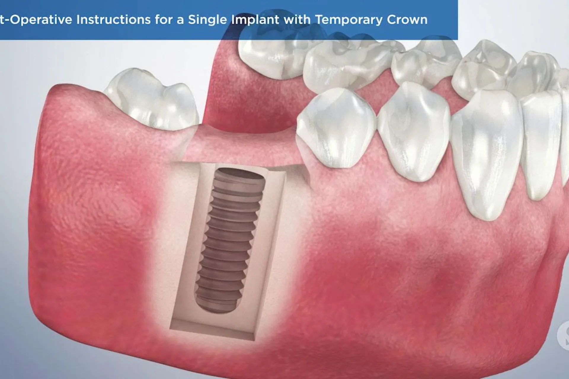 A video still - Post-Operative Instructions for a Single Implant with Temporary Crown with an image showing an implant placed in the gums.
