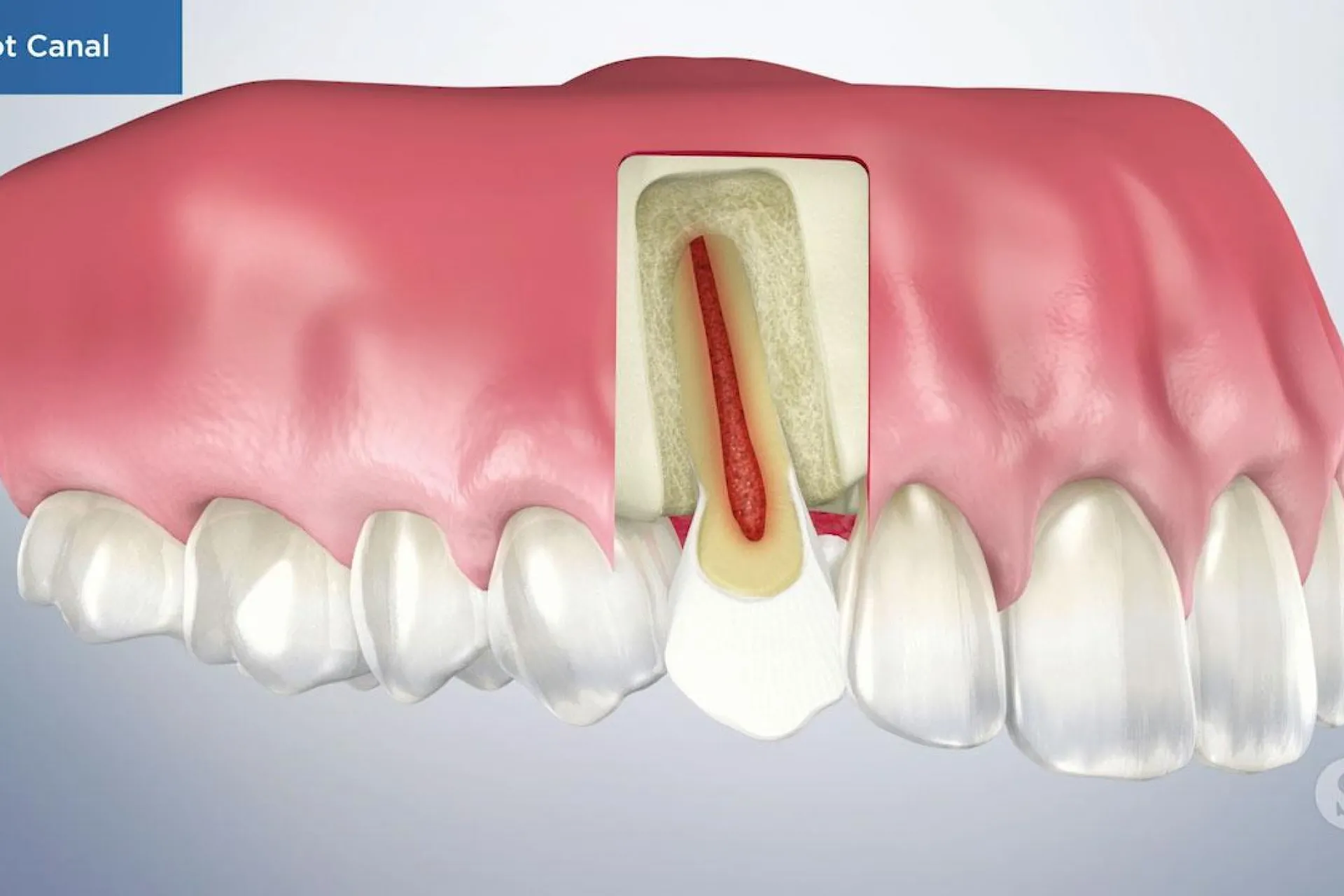 A video still - Root Canal with an image showing the top teeth and gums with a tooth showing a see through the gums to show the root canal.