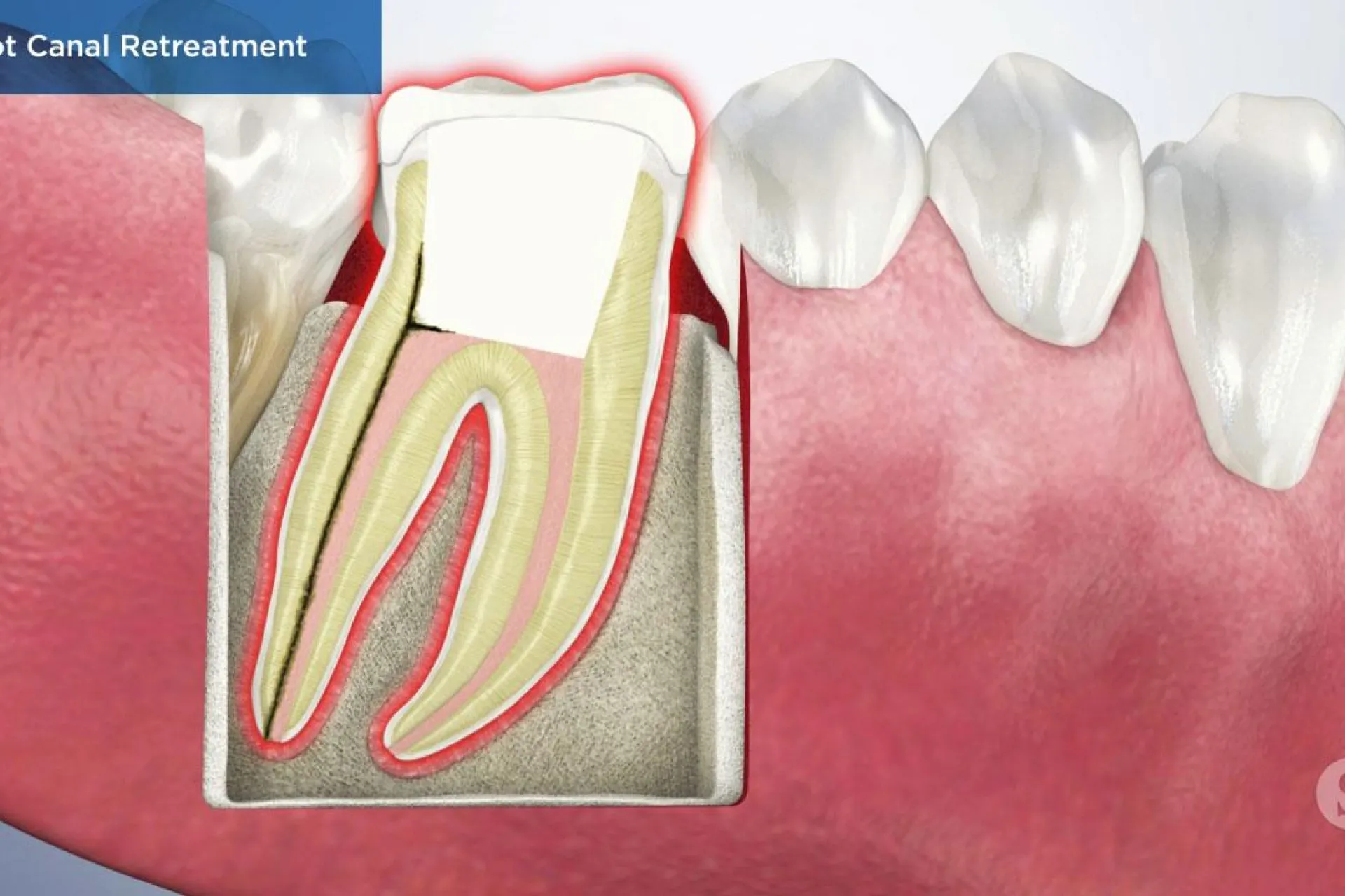 A video still - Root Canal Retreatment with an image showing a close up of the tooth and the root canal.