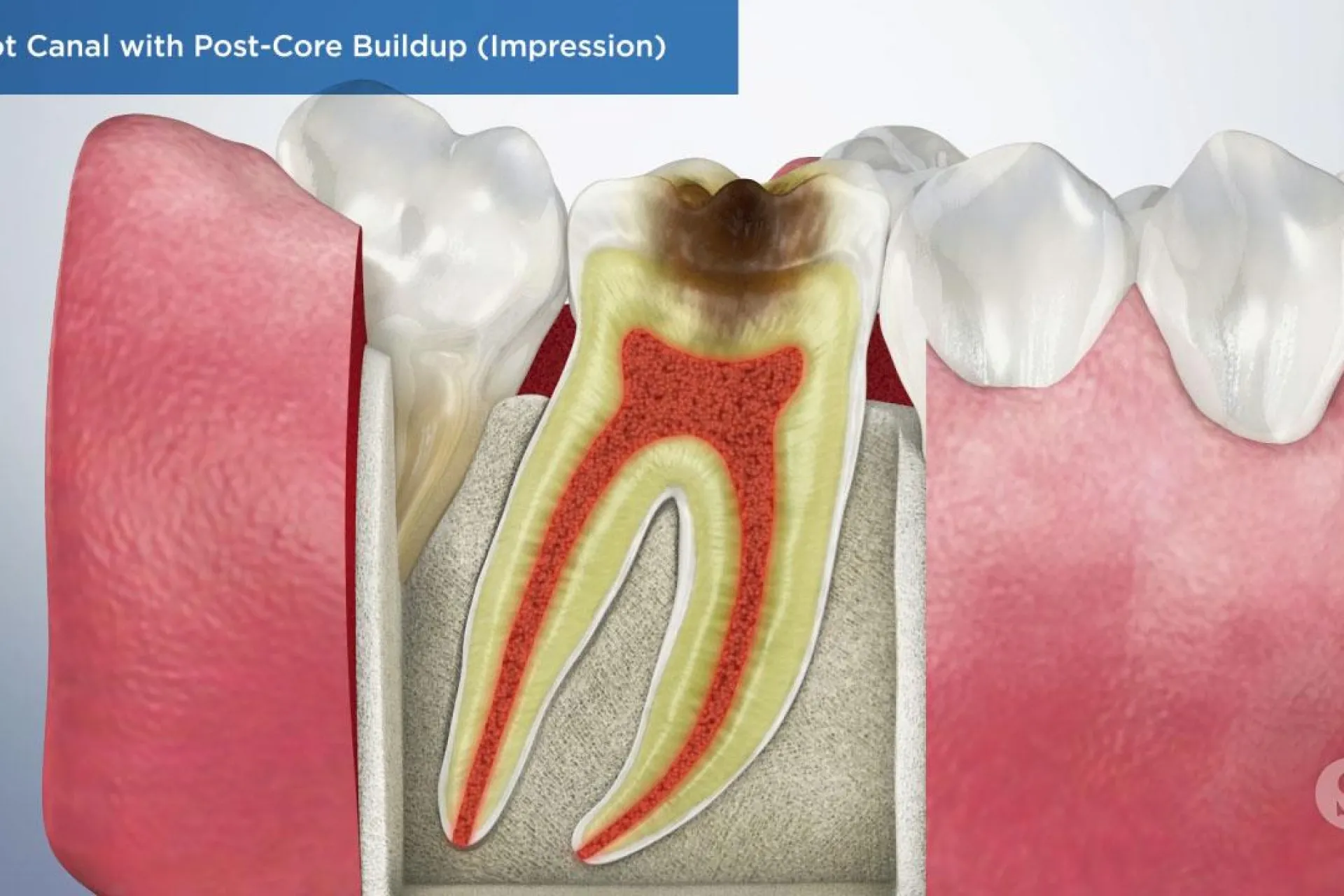 A video still - Root Canal with Post Core Buildup (Impression) with an image still of a root canal of the nerve infected by decay.