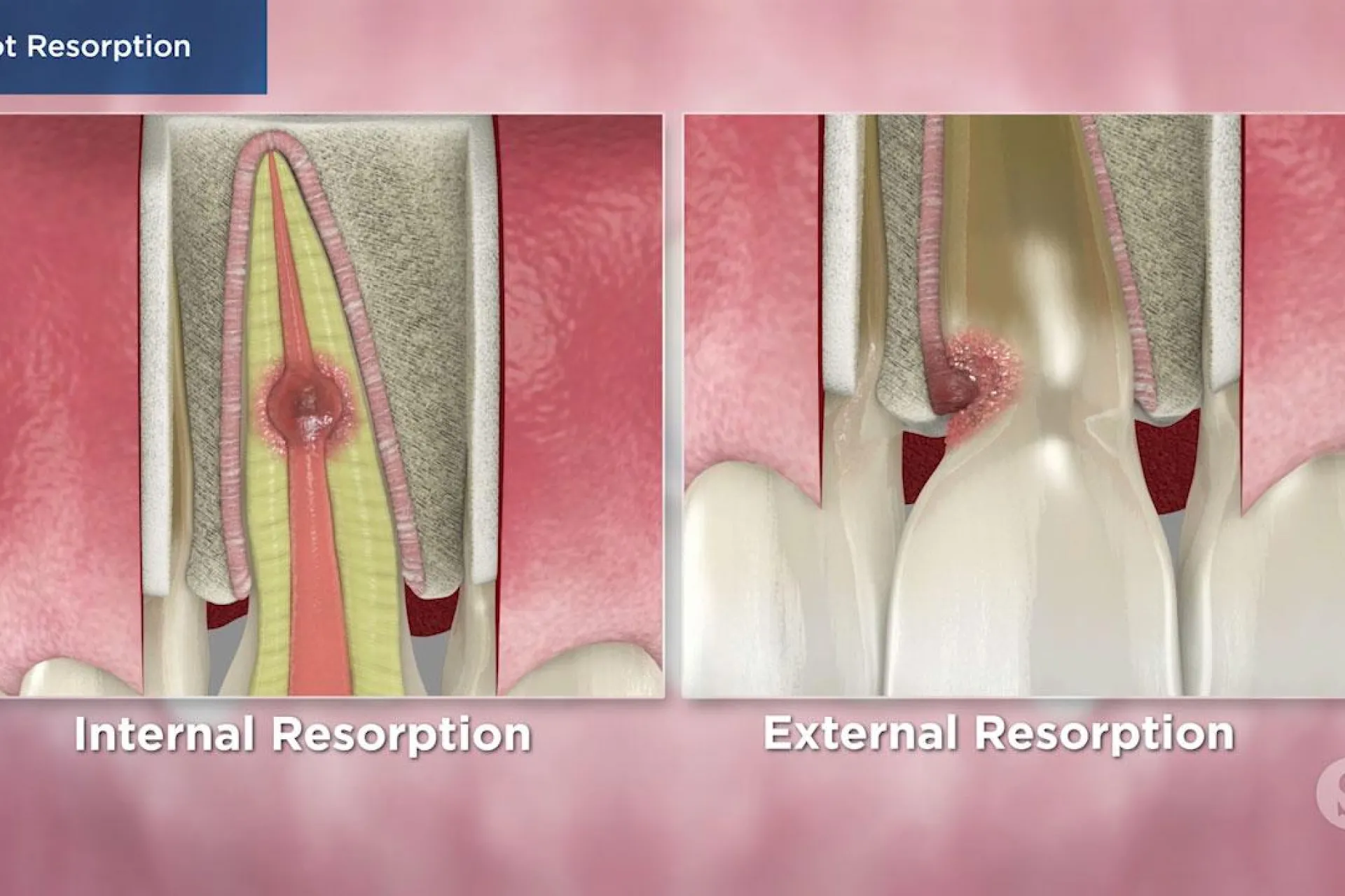 A video still - Root Resorption with an image showing internal and external resportion.