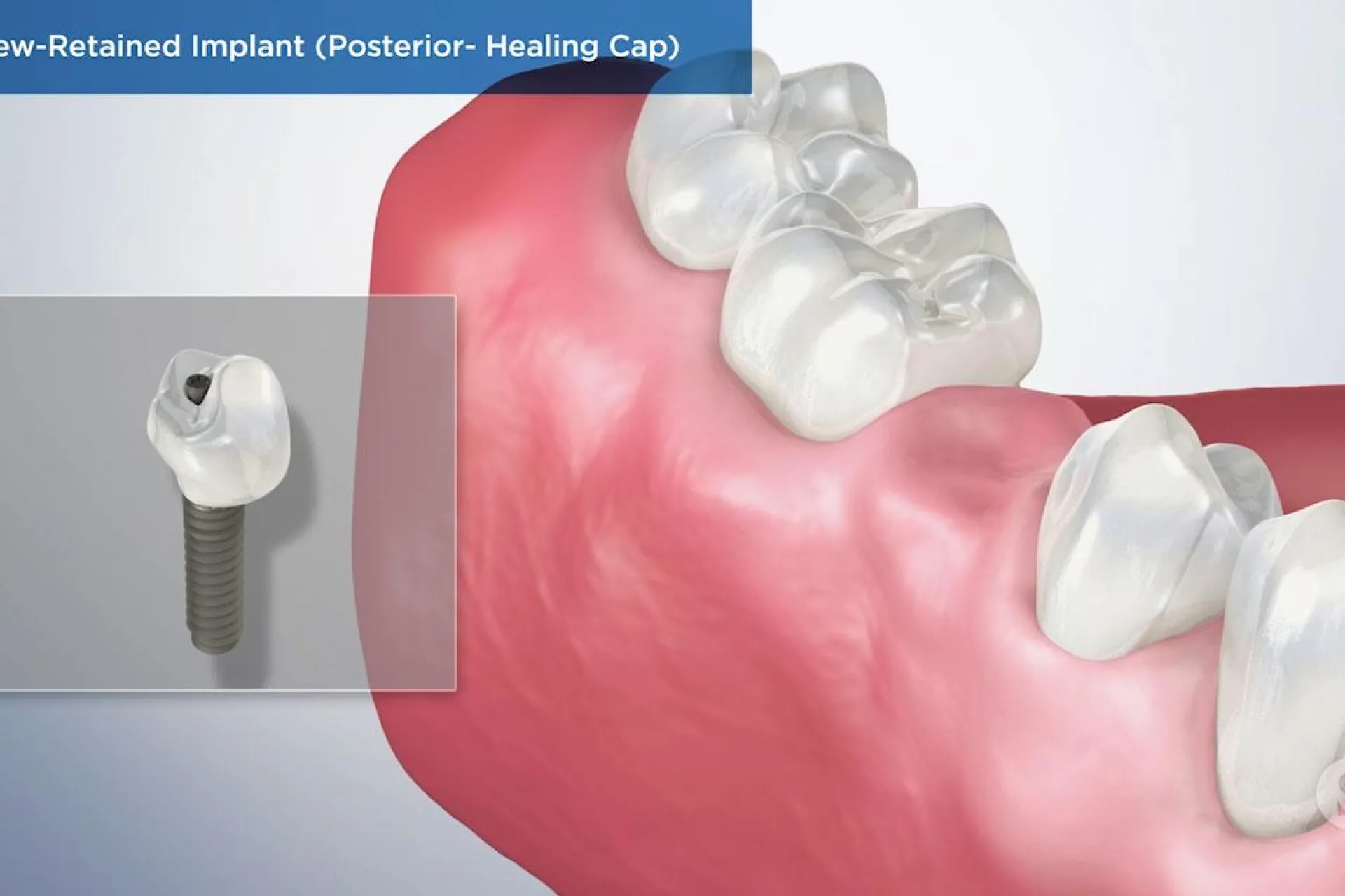 A video still - Screw-Retained Implant (Posterior- Healing Cap) with an image showing an implant next to a set a teeth with a missing tooth.