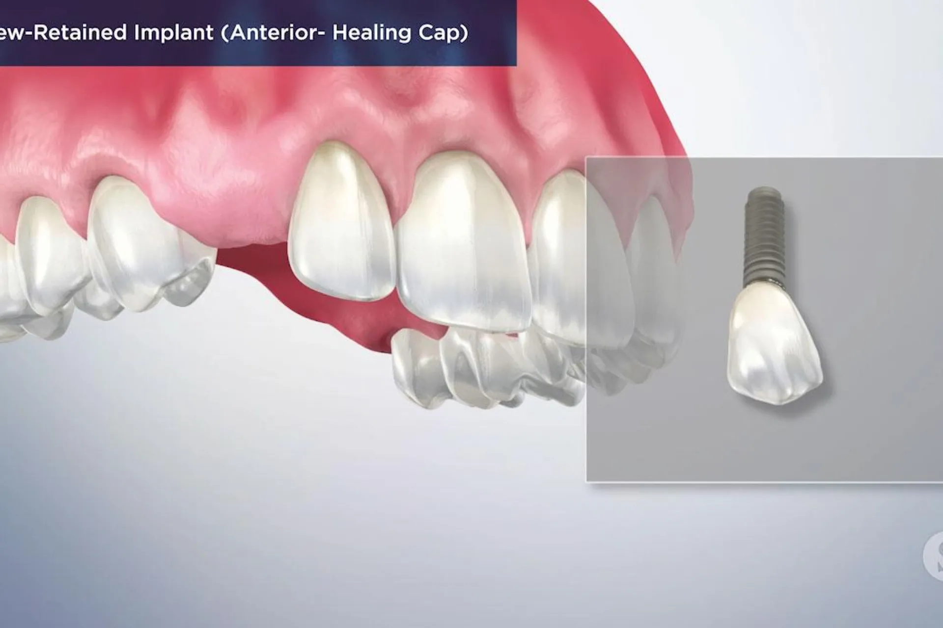 A video still - Screw Retained Implant (Anterior- Healing Cap) with an image showing the top row of teeth with a gap for an implant to be placed.