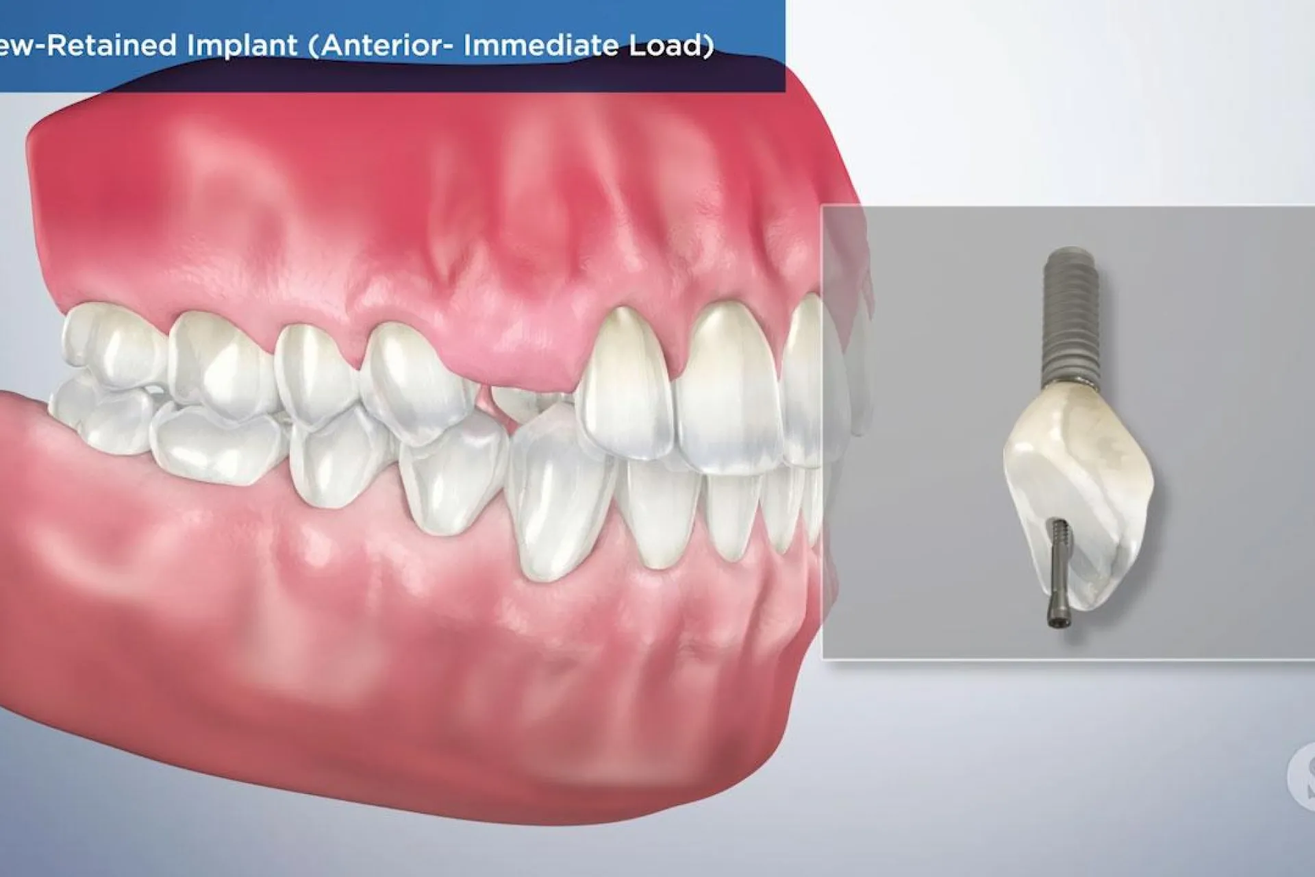 A video still - Screw Retained Implant (Anterior- Immediate Load) with an 3d image of the teeth and gums with a missing tooth where an implant to go.