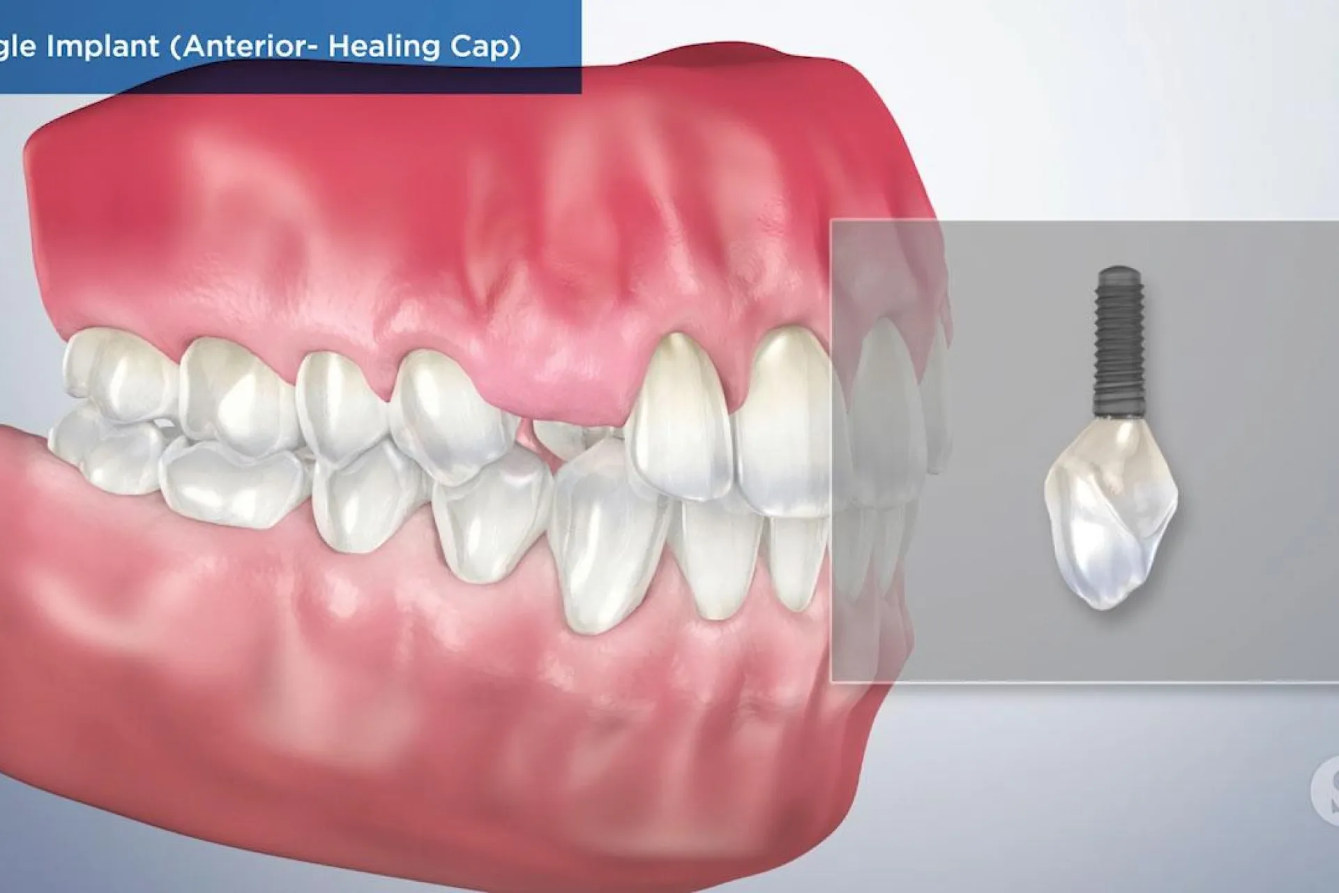 A video still - Single Implant (Anterior- Healing Cap) with an image showing the gums and teeth with a close up of the single implant.