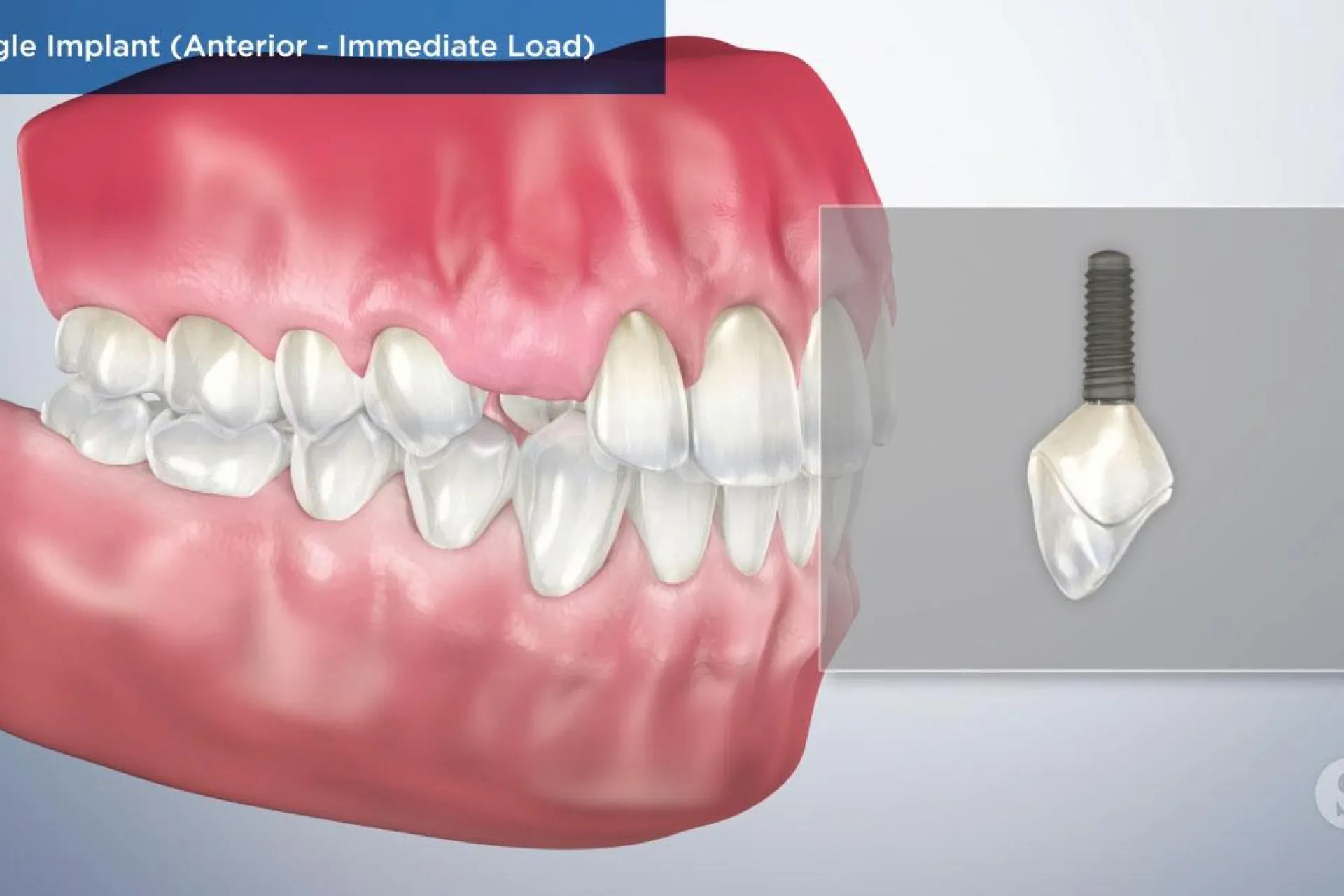 A video still - Single Implant (Anterior- Immediate Load) showing an image with teeth and gums with a single implant next to them.