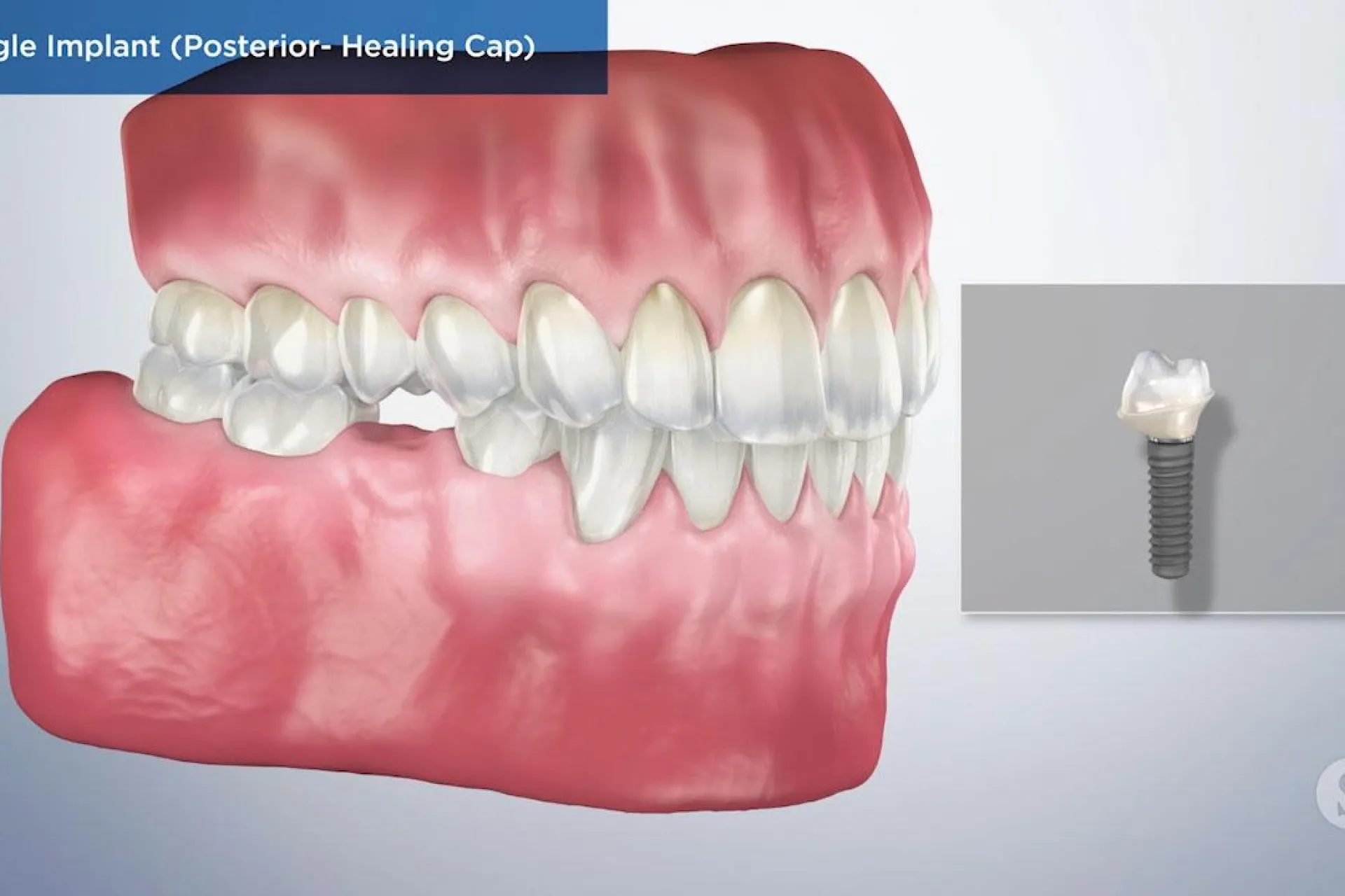 A video still - Single Implant (Posterior- Healing Cap) showing an image of teeth and gums with a single implant next to it that will be inserted.
