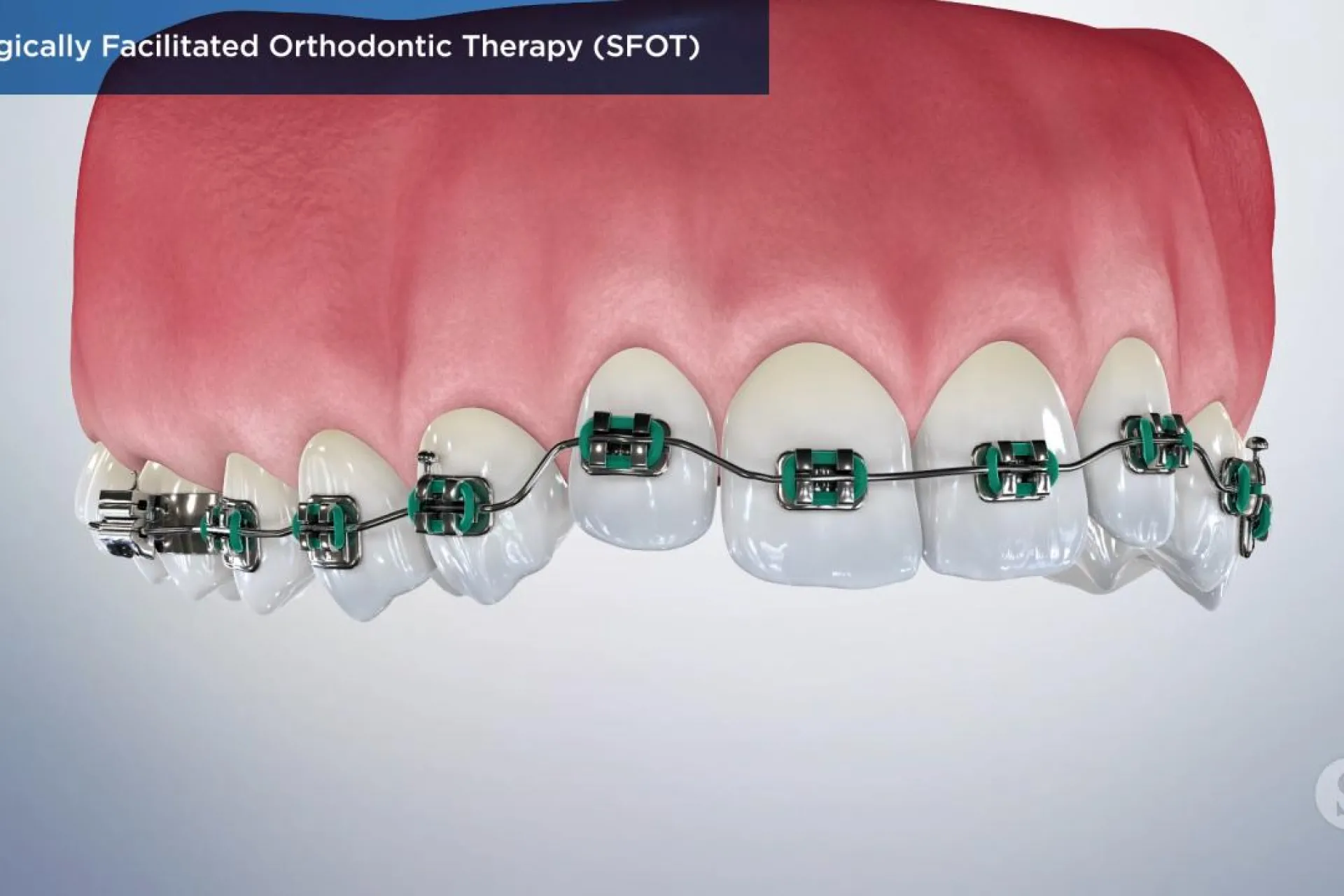 A video still - Surgically Facilitated Orthodontic Therapy showing an image of the top teeth with braces on them.