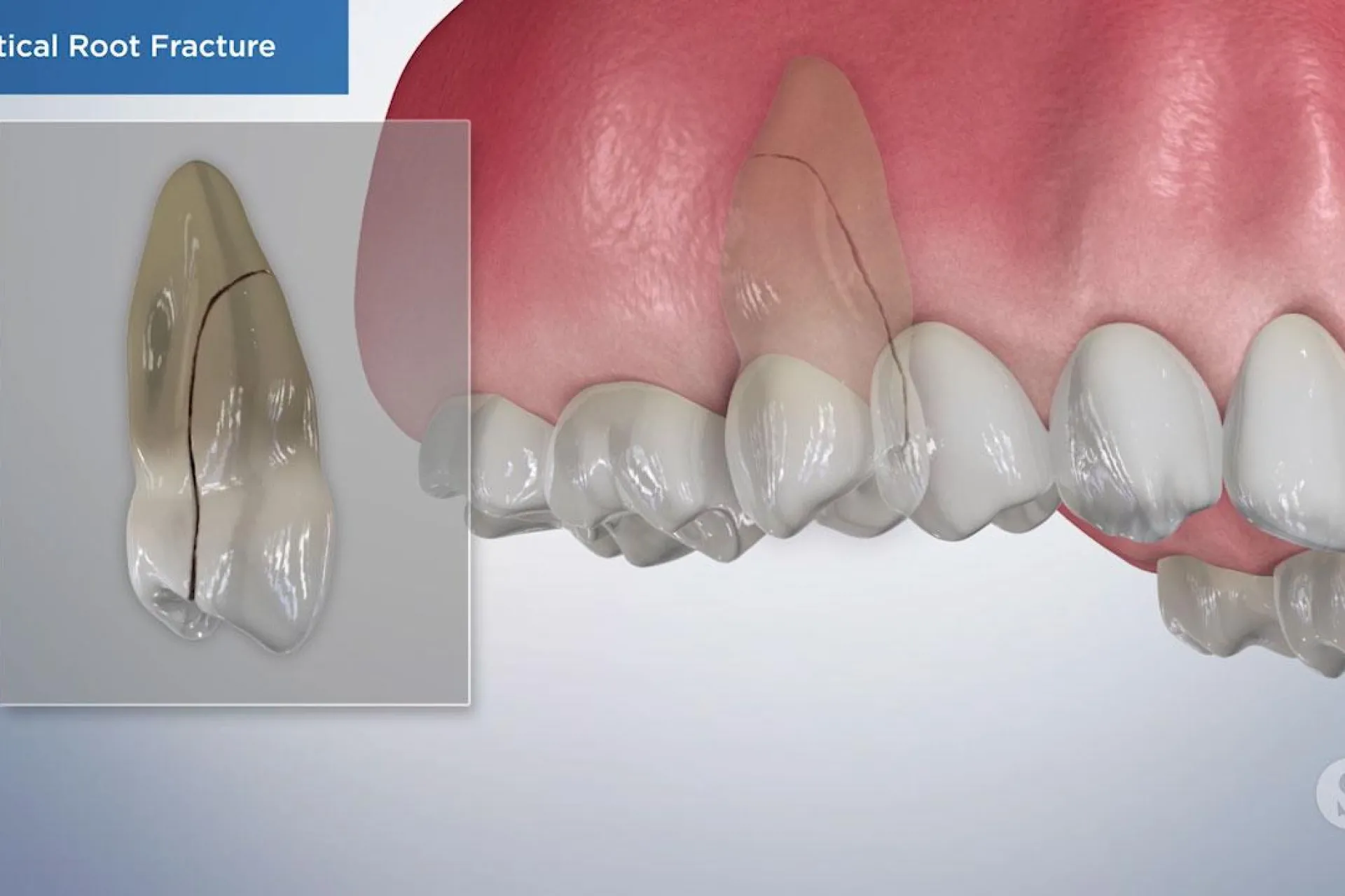 a video still - vertical root fracture with an image showing a tooth with a fracture in the root that's vertical.