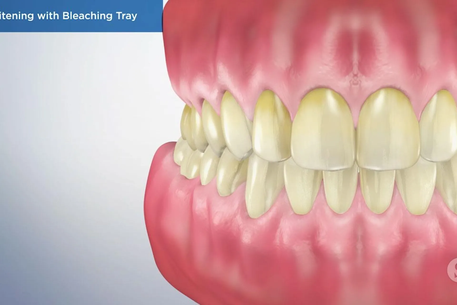 A video still - Whitening with Bleaching Tray with an image showing teeth that are yellow.