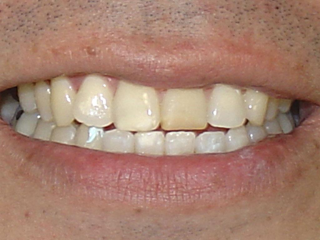 case 009 smile before photo