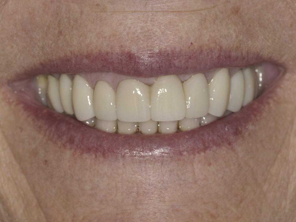 case 0111 smile after photo