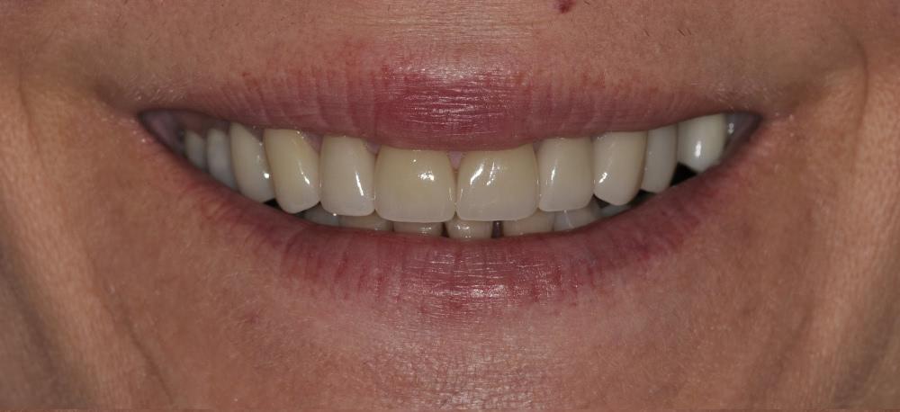 An after photo of a woman with a noticeable teeth gap repair