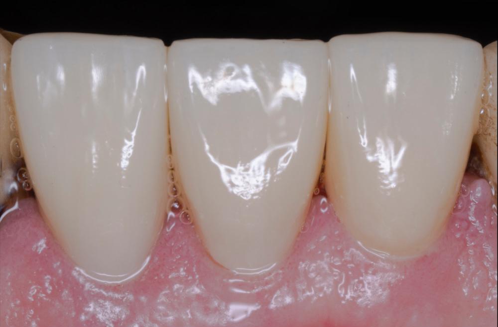 Before closeup of teeth crowns