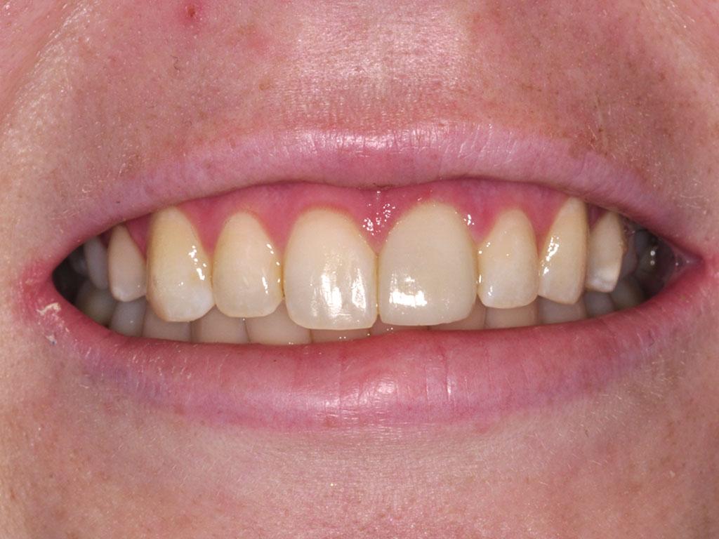 case 040 smile after photo