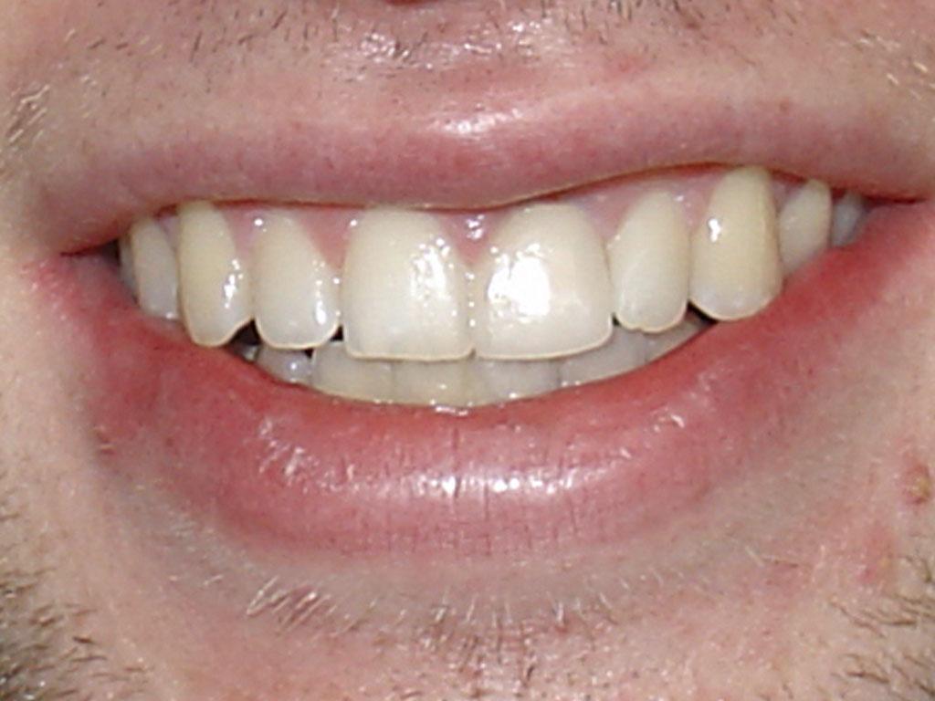 case 046 smile after photo