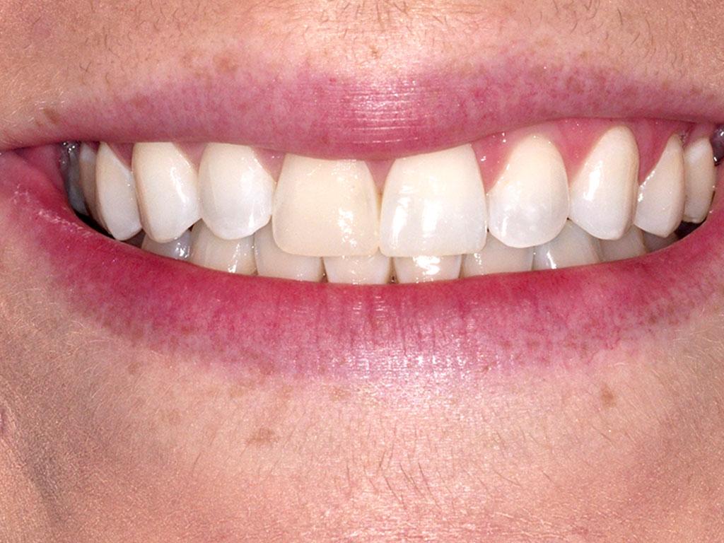 case 048 smile before photo