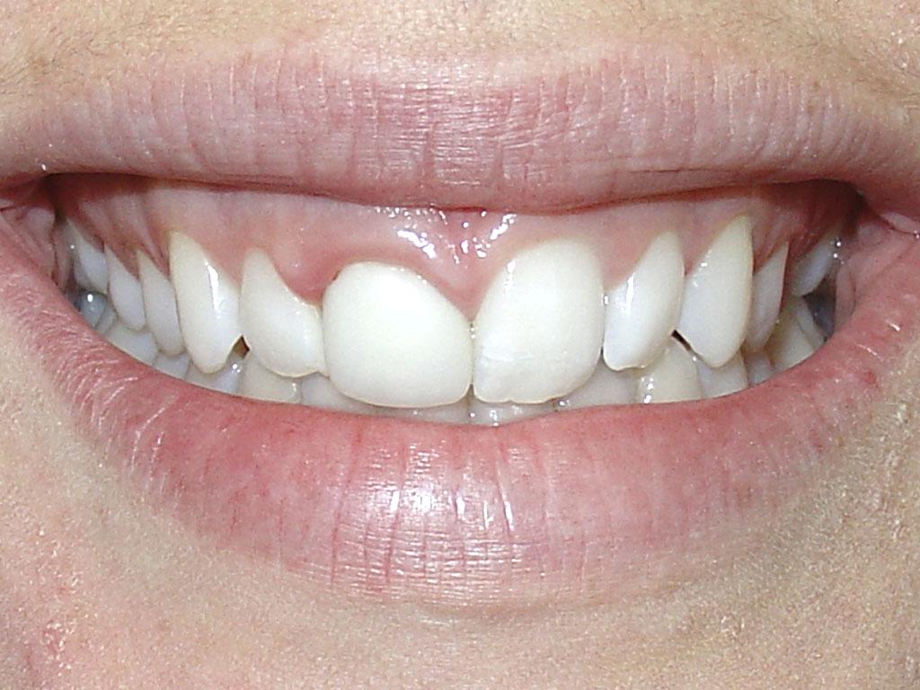 case 055 smile after photo