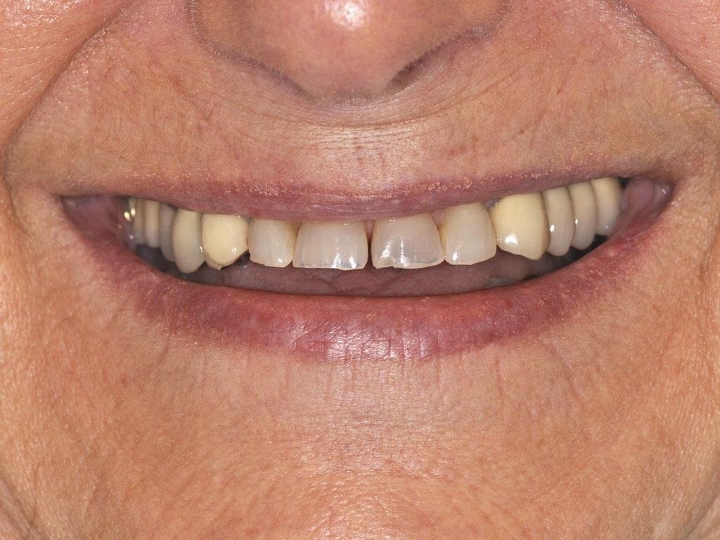 case 064 smile before photo