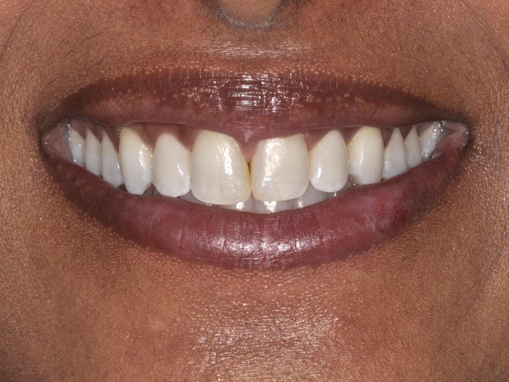 case 072 smile after photo