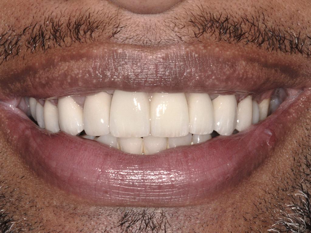 case 080 smile after photo