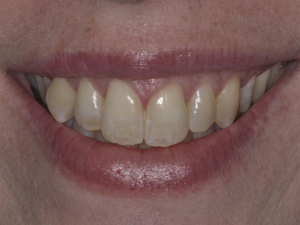 case 308 smile before photo